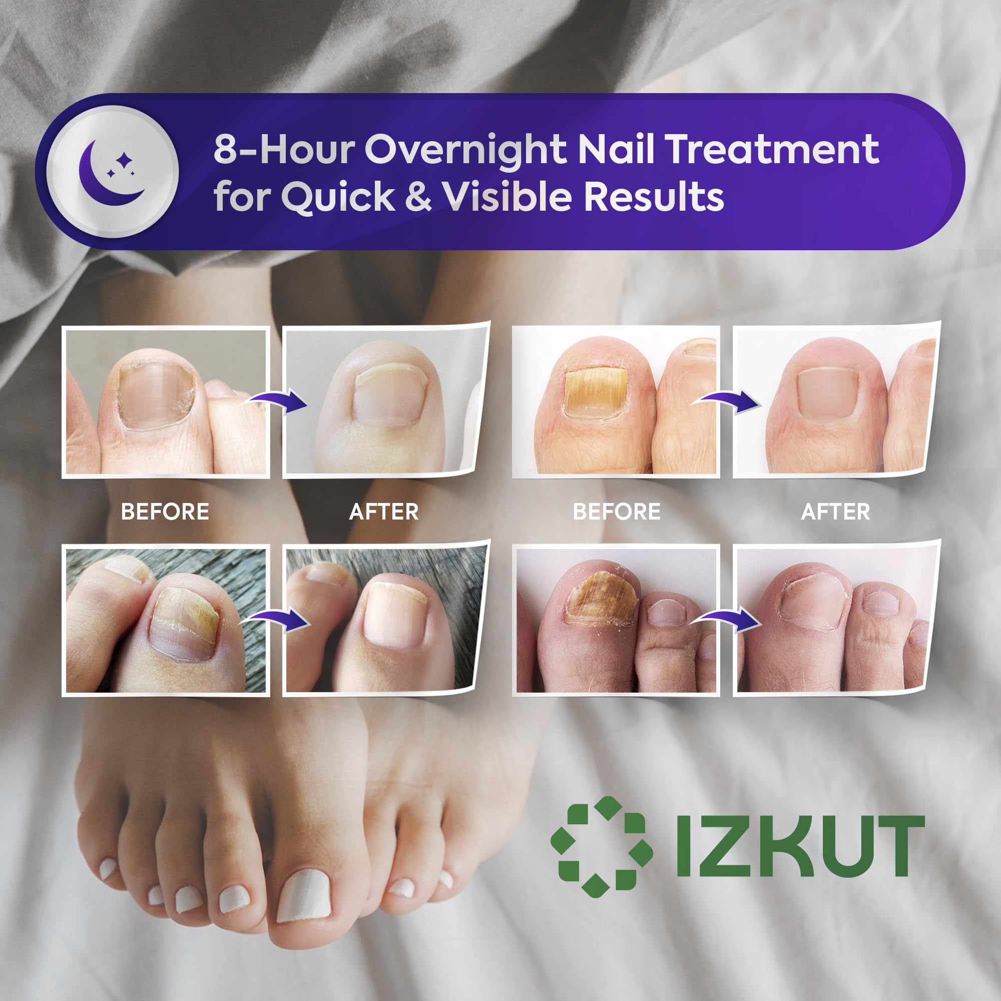Toenail Fungus Treatment Patches - 32 Medicated Patches with 1% Tolnaftate for Effective Fungal Nail Repair | 8-Hour Overnight Renewal | Doctor-Recommended Solution for Athlete's Foot & Nail Fungus | Perfect for Nighttime Use During Sleep