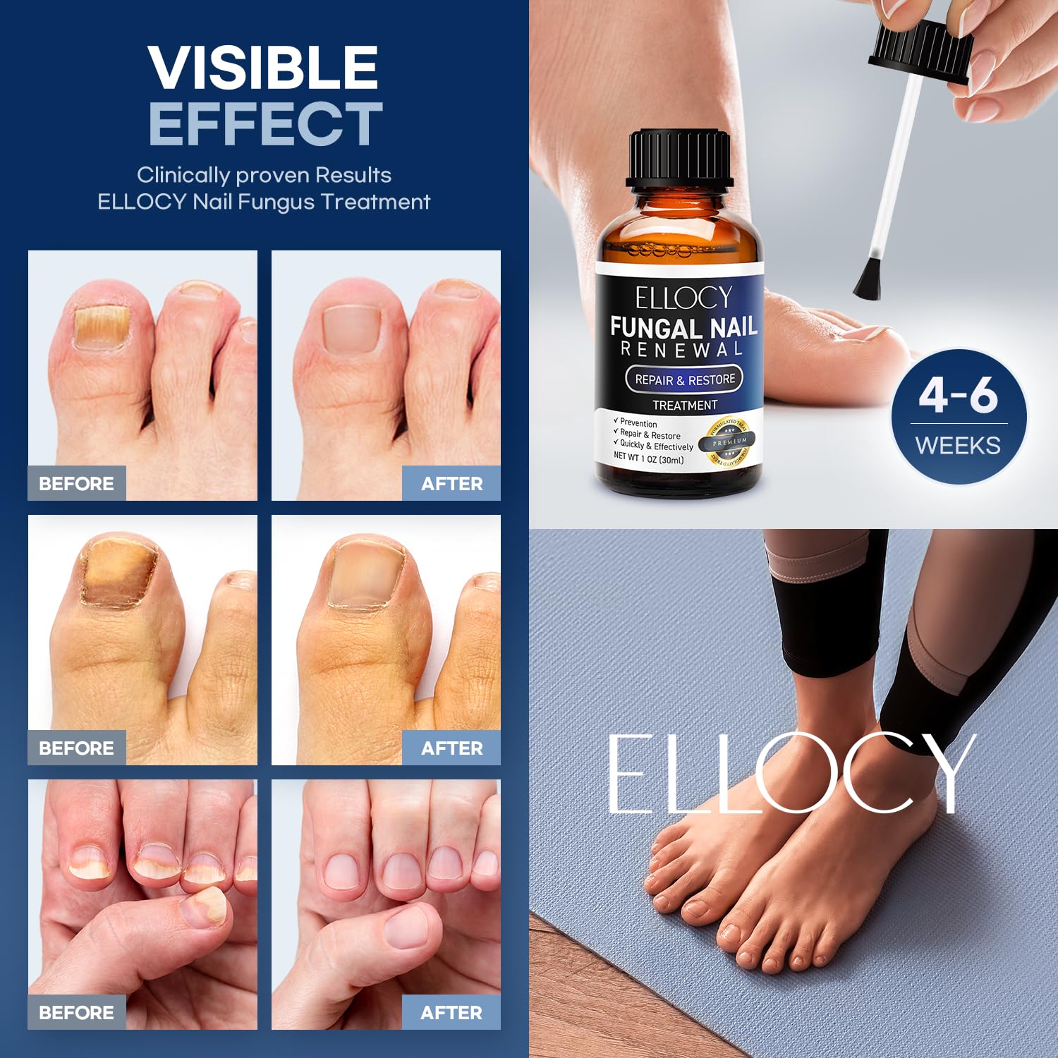Extra Strength Toenail Fungus Treatment - Repair Damaged Nails & Fight Fungal Infections | Nail Repair Liquid 30ml | Ideal for Athletes, Swimmers & Active Lifestyles