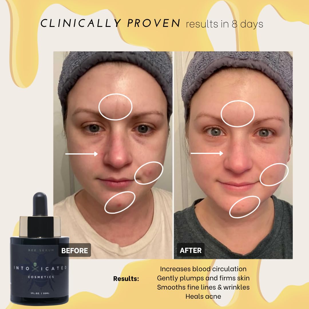 Bee Venom Serum for Anti-Aging & Acne Treatment - Breakout Prevention with Niacinamide, Vitamin C+E, Hyadisine & Royal Epigen P5 | Brightening Face Serum for Daily Skincare Routine