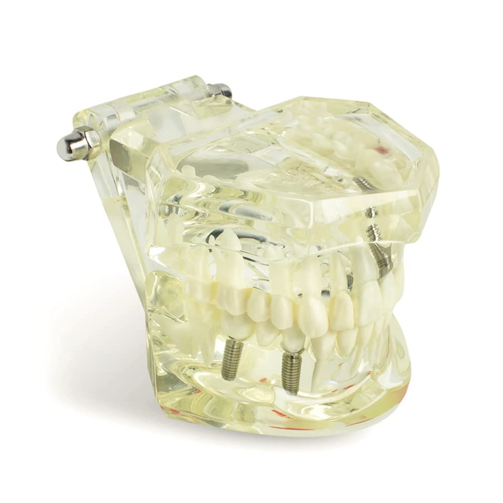 Dental Teeth Model - Transparent Implant Disease Removable Tooth Demonstration Kit for Dental Students & Professionals | Perfect for Classroom Teaching, Clinical Training & Patient Education
