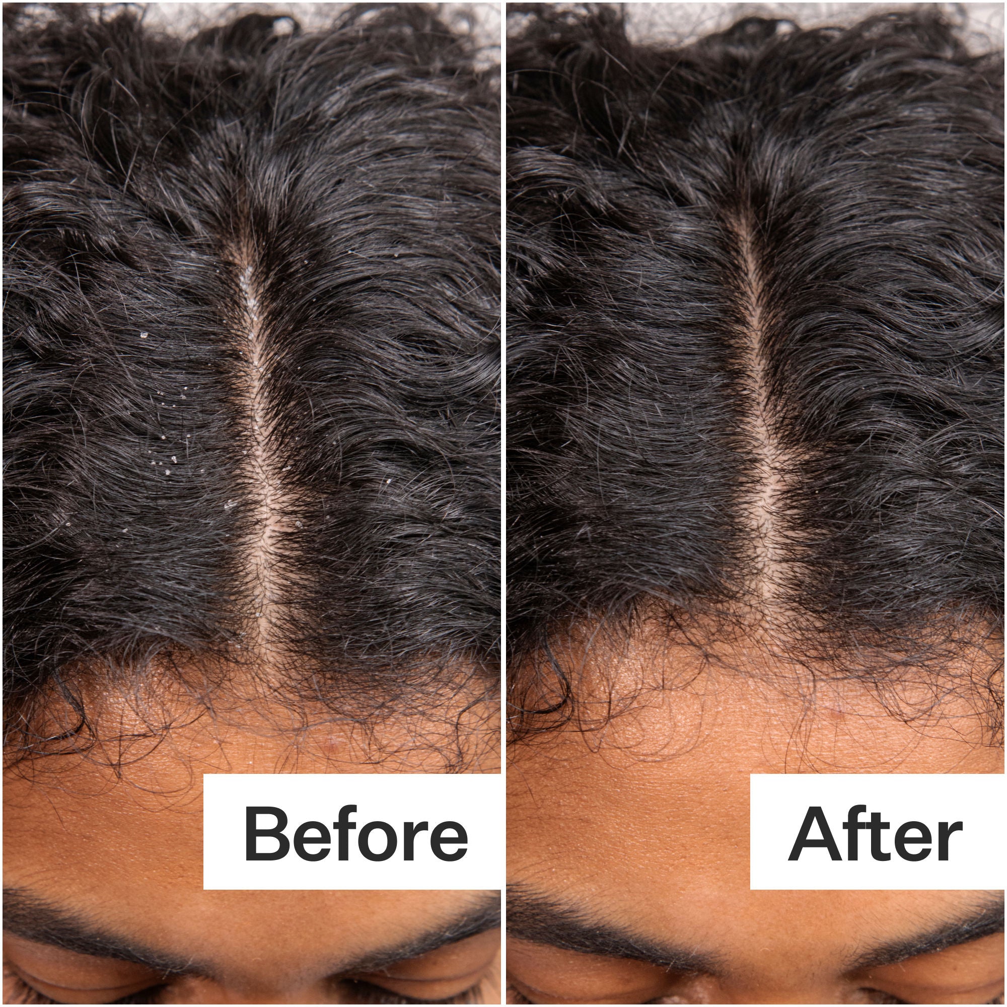 Hyaluronic Acid Scalp Serum for Dry Scalp - Daily Hydrating Treatment for Itchy, Flaky Scalp | Perfect for Men & Women with Dandruff or Scalp Irritation