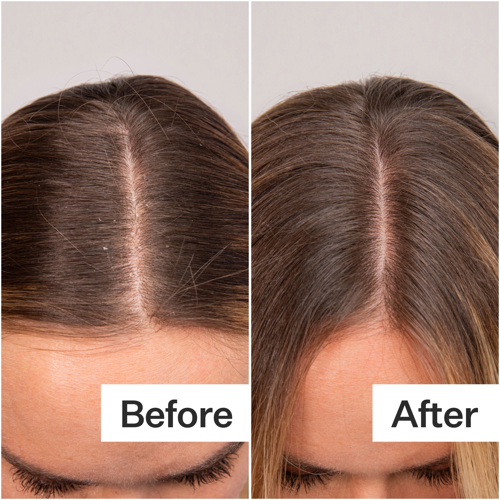 Hyaluronic Acid Scalp Serum for Dry Scalp - Daily Hydrating Treatment for Itchy, Flaky Scalp | Perfect for Men & Women with Dandruff or Scalp Irritation
