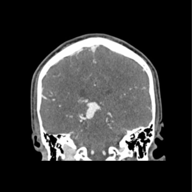 CTA AVM Head Phantom for CT Scan & X-Ray Training - Medical Imaging Practice, Radiology Education & Diagnostic Testing Simulation