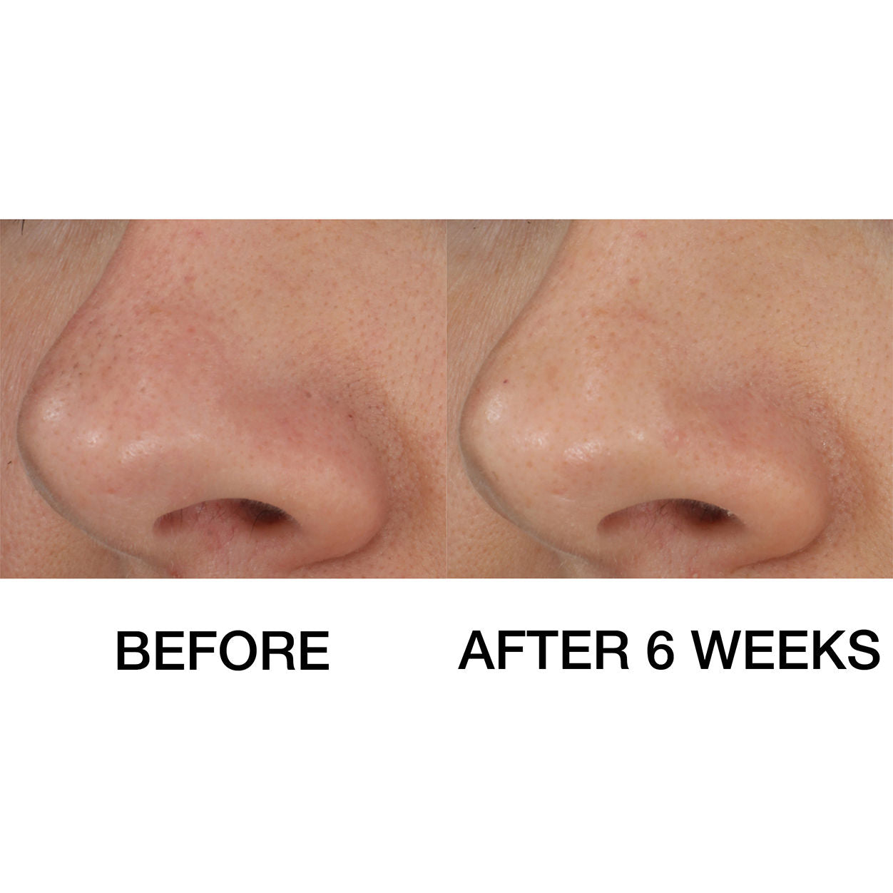 Blackhead Solutions Self Heating Blackhead Extractor - Pore Cleanser & Blackhead Remover for Face - Perfect for Daily Skincare & Spa Treatments