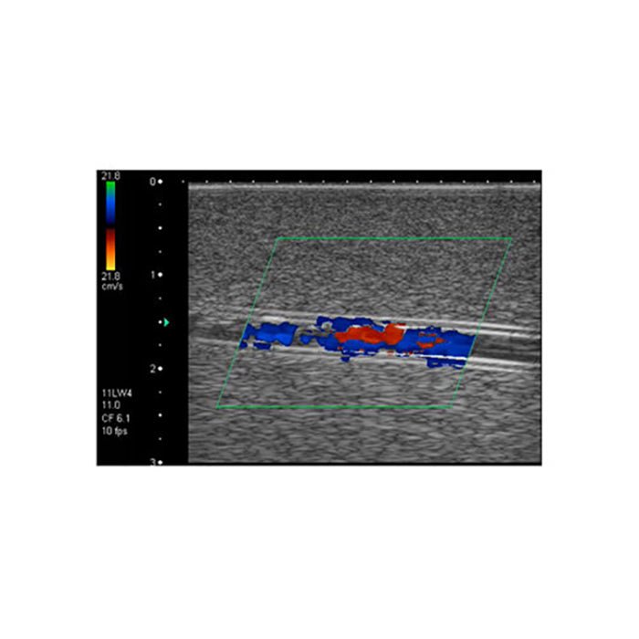 Deep Vein Thrombosis (DVT) Training Phantom Model - Medical Simulation Device for Ultrasound Practice & Vascular Diagnosis Training