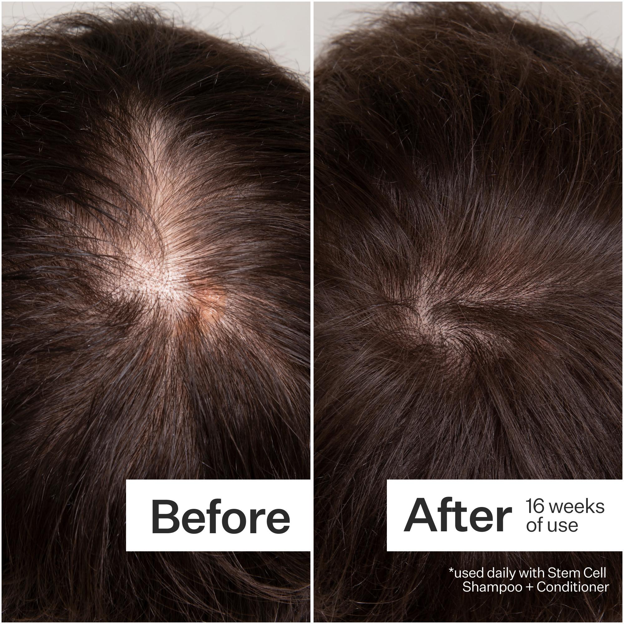 Act+Acre 3% Stem Cell Peptide Hair Treatment for Thinning Hair - Stimulates Hair Growth & Reduces Breakage - Perfect for Daily Scalp Care & Hair Regrowth Routine
