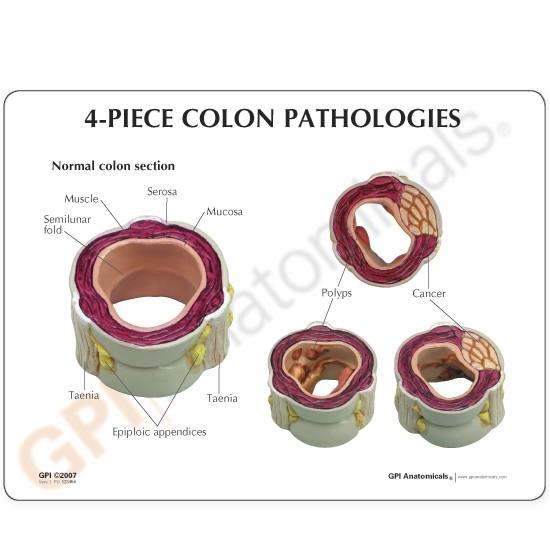 4-Piece Colon Anatomy Model with Pathologies - Ideal for Medical Students, Doctors & Healthcare Professionals