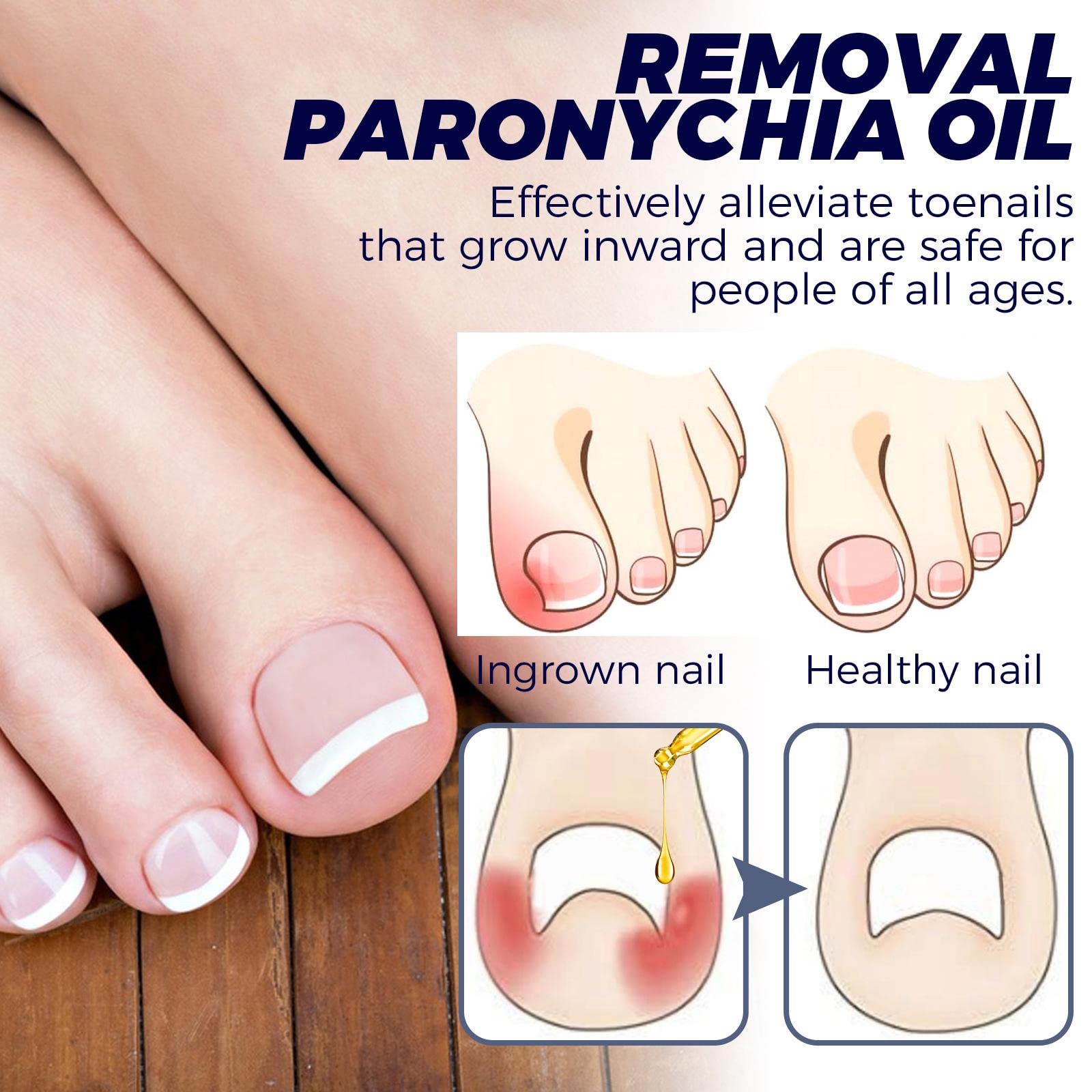 Pinakine® Professional Toenail Repair Solution - Fungal Nail Treatment, Thick Toenail Corrector, Foot Care Cream for Healthy Nails - 10ml (75026910PNK) | Perfect for Athletes, Pedicures & Daily Foot Care