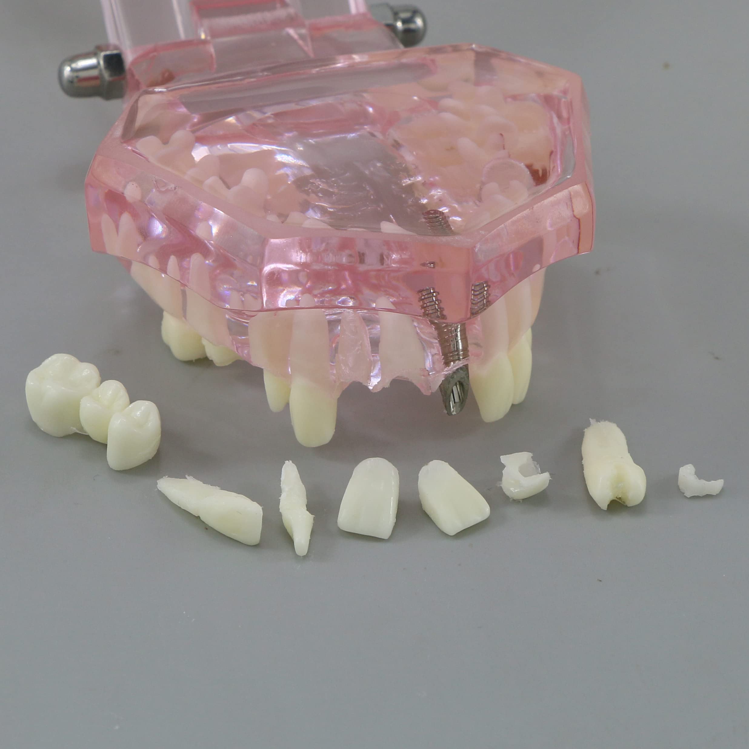 Dental Teeth Model - Implant Restoration Bridge Typodont for Dental Teaching & Study - Oral Pathology Demonstration (M2001 Pink) - Perfect for Dental Schools, Clinics & Training Labs