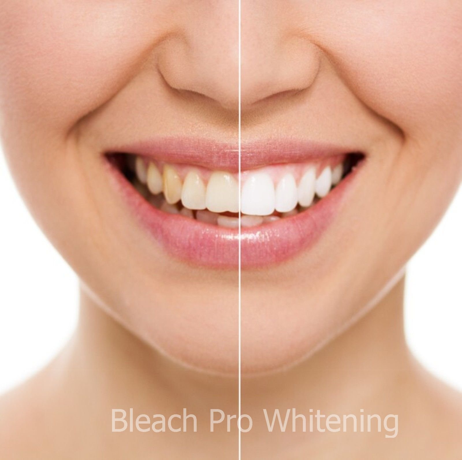 Professional Teeth Whitening Gel Syringe Kit - 22% Carbamide Peroxide, 10 x 3ml Dental Bleaching Syringes for Brighter Smile | At-Home Teeth Whitening Treatment for Coffee & Wine Stains Removal