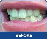 Professional Teeth Whitening Gel Syringe - 36% Carbamide Peroxide, 10ml for Instant White Smiles - Includes Whitening Trays - Perfect for At-Home Teeth Whitening & Brightening Your Smile for Special Occasions