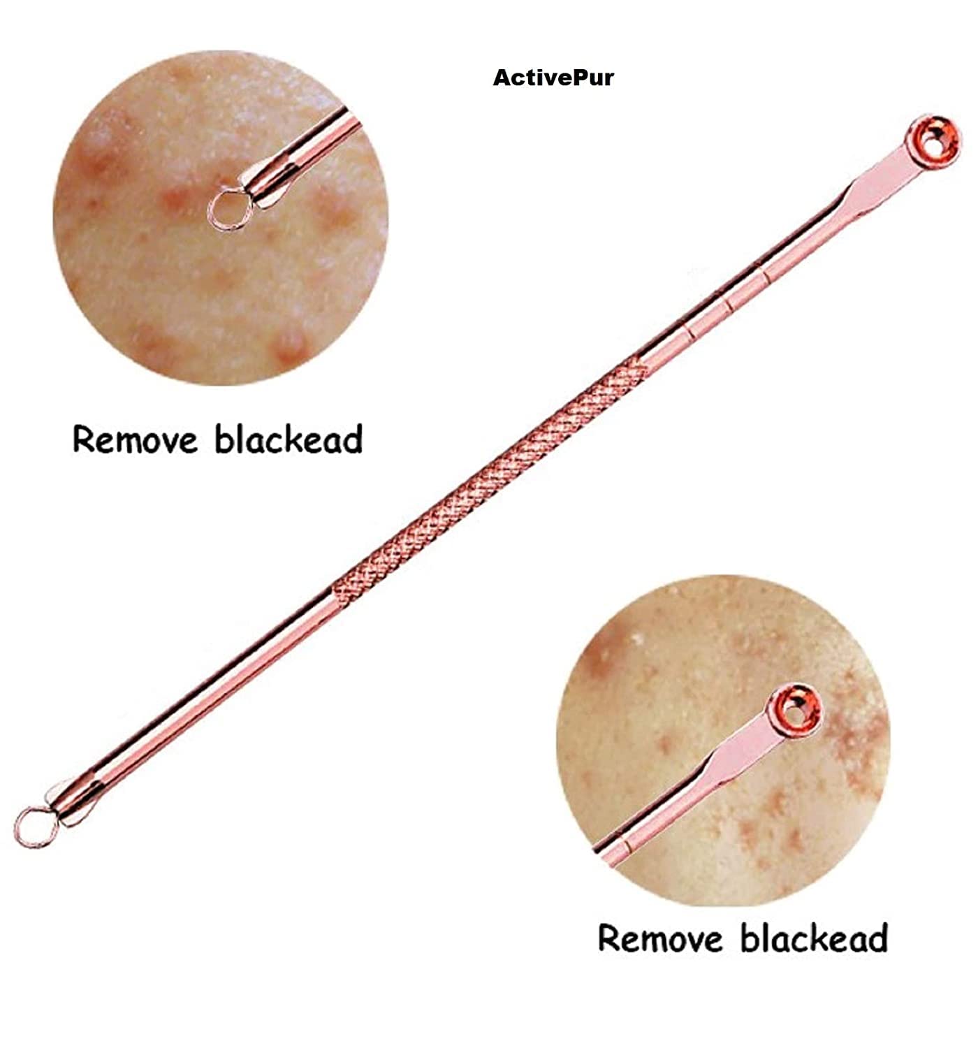 Professional Blackhead & Pimple Remover Kit - 4-Piece Acne Extractor Tool for Whitehead & Comedone Removal | Safe for Face, Nose & Skin | Includes Travel Case | Perfect for Home Skincare & Spa Treatments