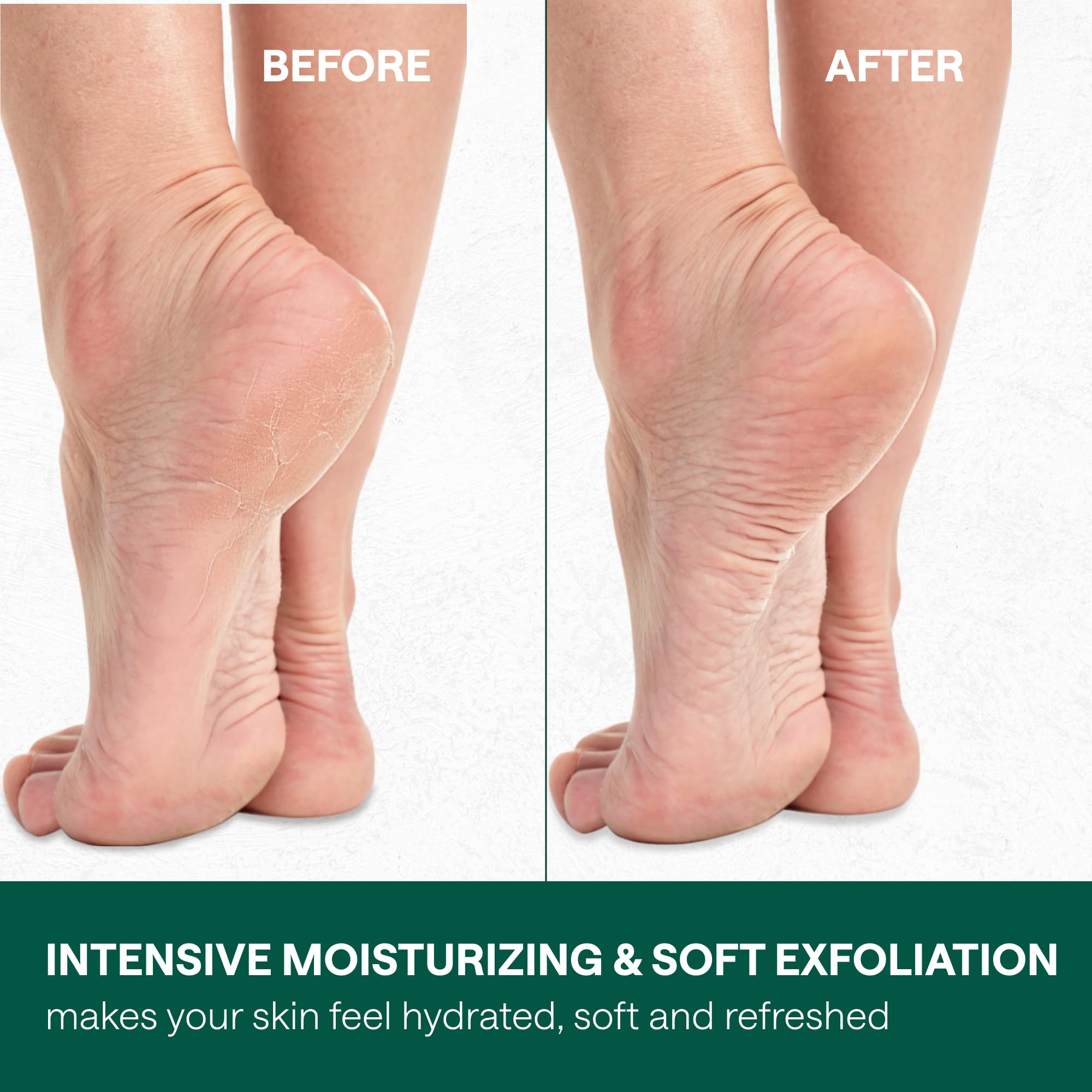 40% Urea Foot Cream with 2% Salicylic Acid, Aloe & Tea Tree Oil - Maximum Strength Athlete's Foot Treatment & Cracked Heel Repair - Intense Moisturizing Dry Skin Cream for Hands & Feet - Perfect for Daily Foot Care & Cracked Skin Relief