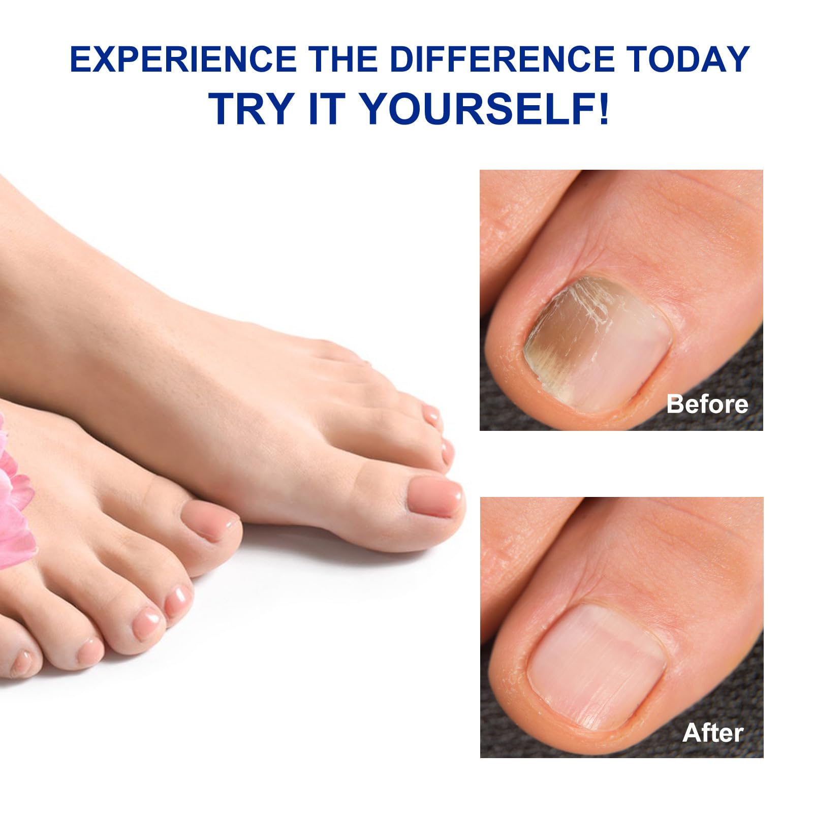 Toenail Fungus Treatment - 8 Hour Overnight Renewal Fungal Nail Patches (32 Count) - Effective Solution for Toenail Fungus Infection & Nail Repair - Perfect for Nighttime Use While Sleeping
