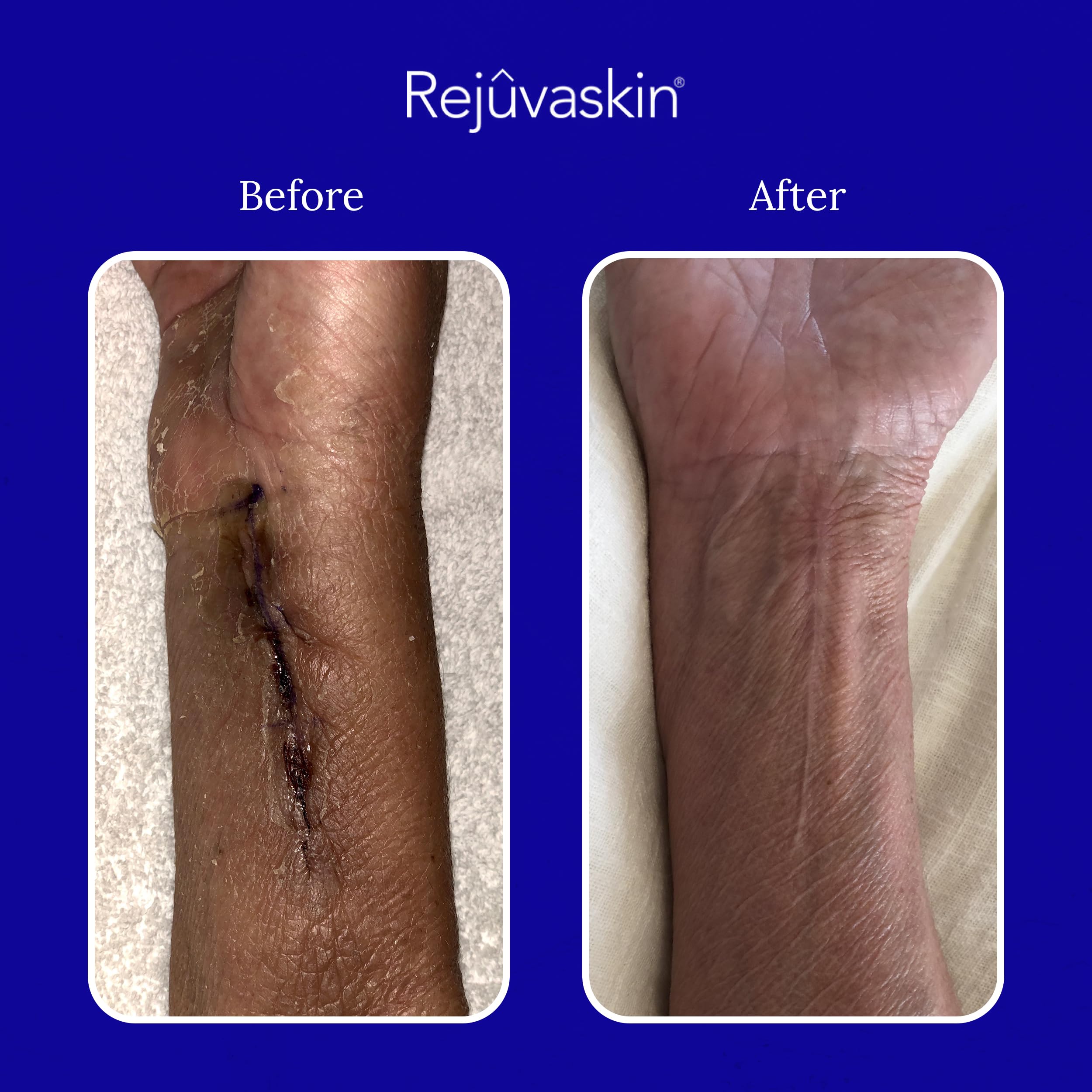 Rejuvaskin Scar Healing Kit for Small Scars - Soften, Flatten & Reduce Appearance with Silicone Sheeting, RejuvaSil Gel & Medical Tape (1.5