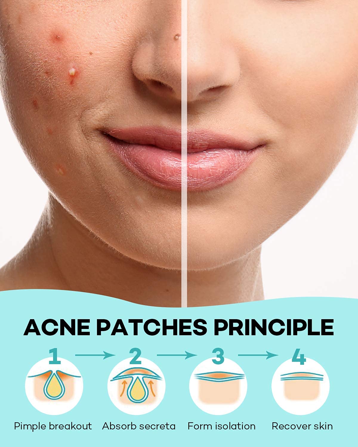 SEFLICA Hydrocolloid Acne Patches for Face - 4 Sizes (72/144 Count) Invisible Pimple Patches with Tea Tree & Calendula Oil - Absorbing Zit Cover for Overnight Spot Treatment | Perfect for Teen Skin Care & Travel Emergency Kit