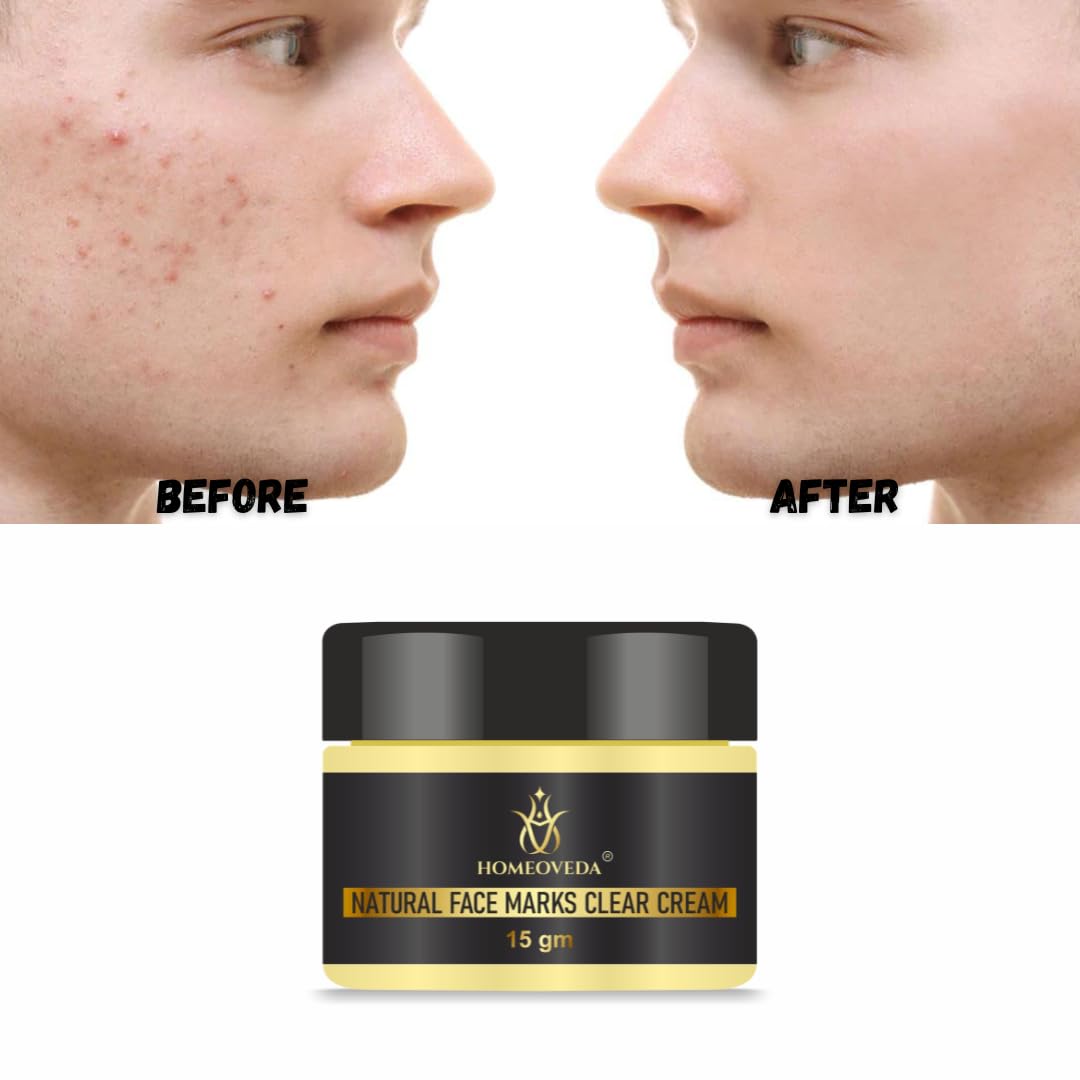 Homeoveda Natural Face Marks Clear Cream - Reduces Acne, Pimples, Blemishes, Pigmentation & Stretch Marks | 15gm | Organic Skincare Solution for Clear, Healthy Skin | Perfect for Daily Use & Post-Acne Care