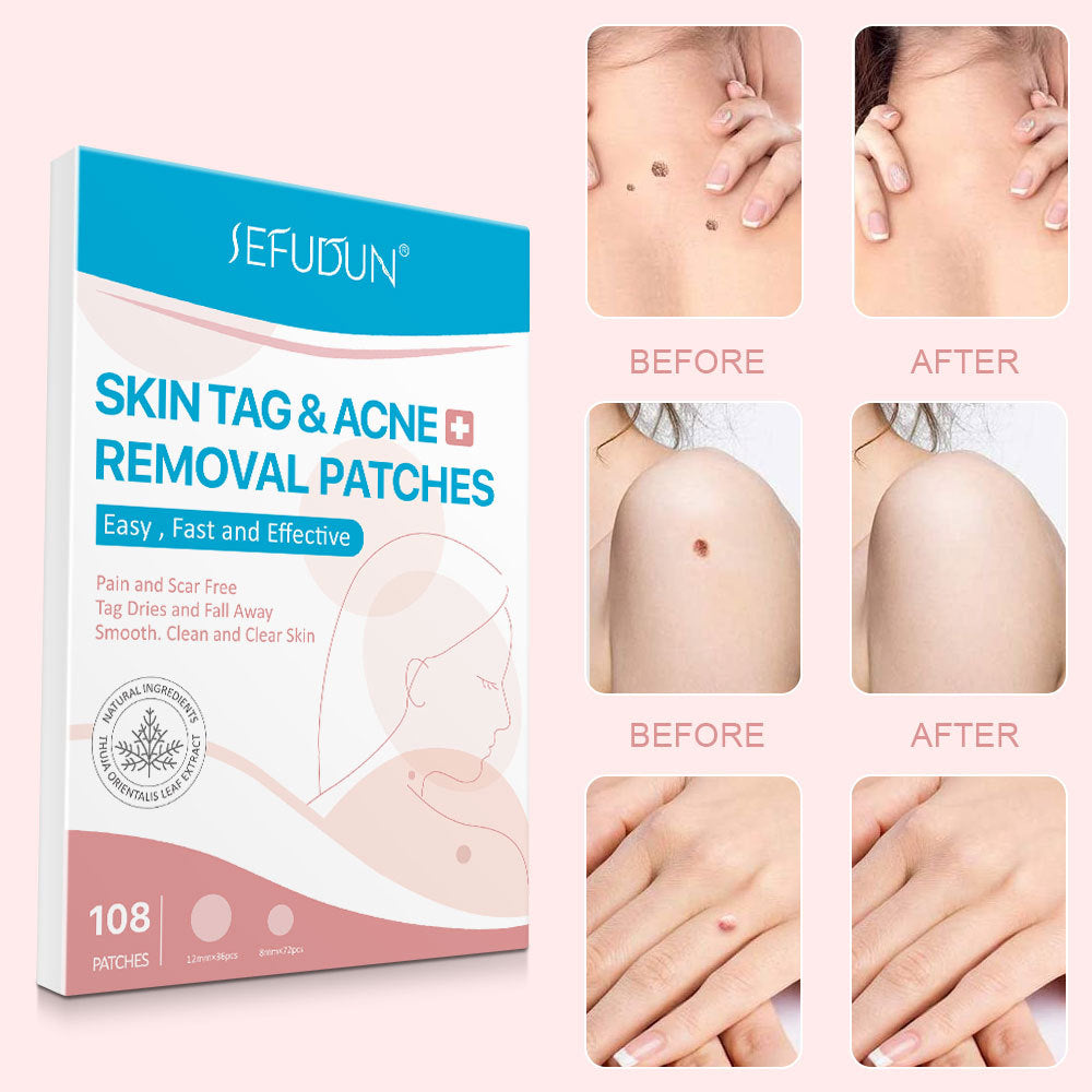 Best Acne Skin Tag Remover & Wart Removal Stickers - Invisible Blackhead Patches for Clear Skin | Perfect for Overnight Treatment & Daily Acne Care