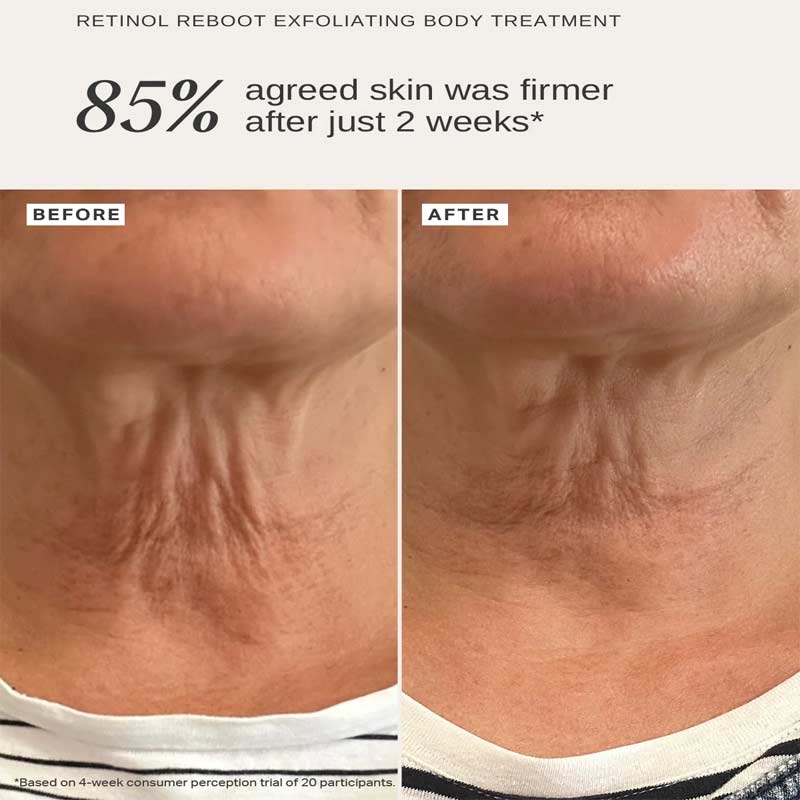 Alpha H Retinol Reboot Exfoliating Body Treatment with 1% Encapsulated Retinol - Anti-Aging Body Lotion for Smooth, Glowing Skin - Perfect for Nighttime Skincare Routine & Dry Skin Care