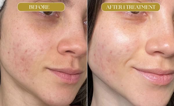 Micro Infusion Anti-Aging Serum with Peptide, EGF, Hyaluronic Acid & Collagen – Boosts Skin Elasticity & Hydration – Reduces Fine Lines & Wrinkles – 3 Vials (15ml/0.51 fl oz) – Perfect for Nighttime Skincare Routine & Daily Anti-Aging Treatment