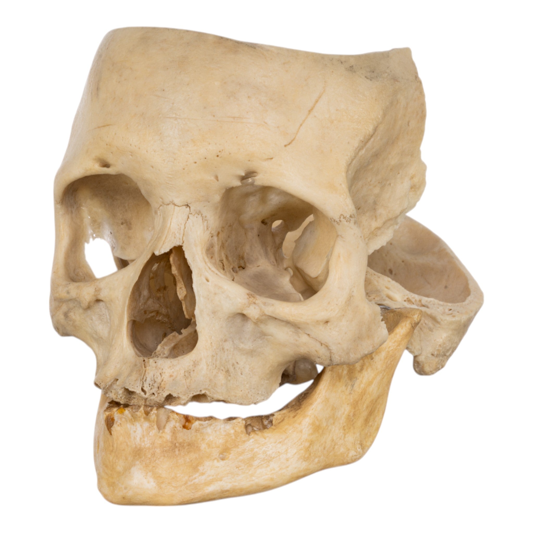 Real Human Skull Partial - Authentic Medical Specimen for Anatomy Study, Halloween Decor & Gothic Collectibles