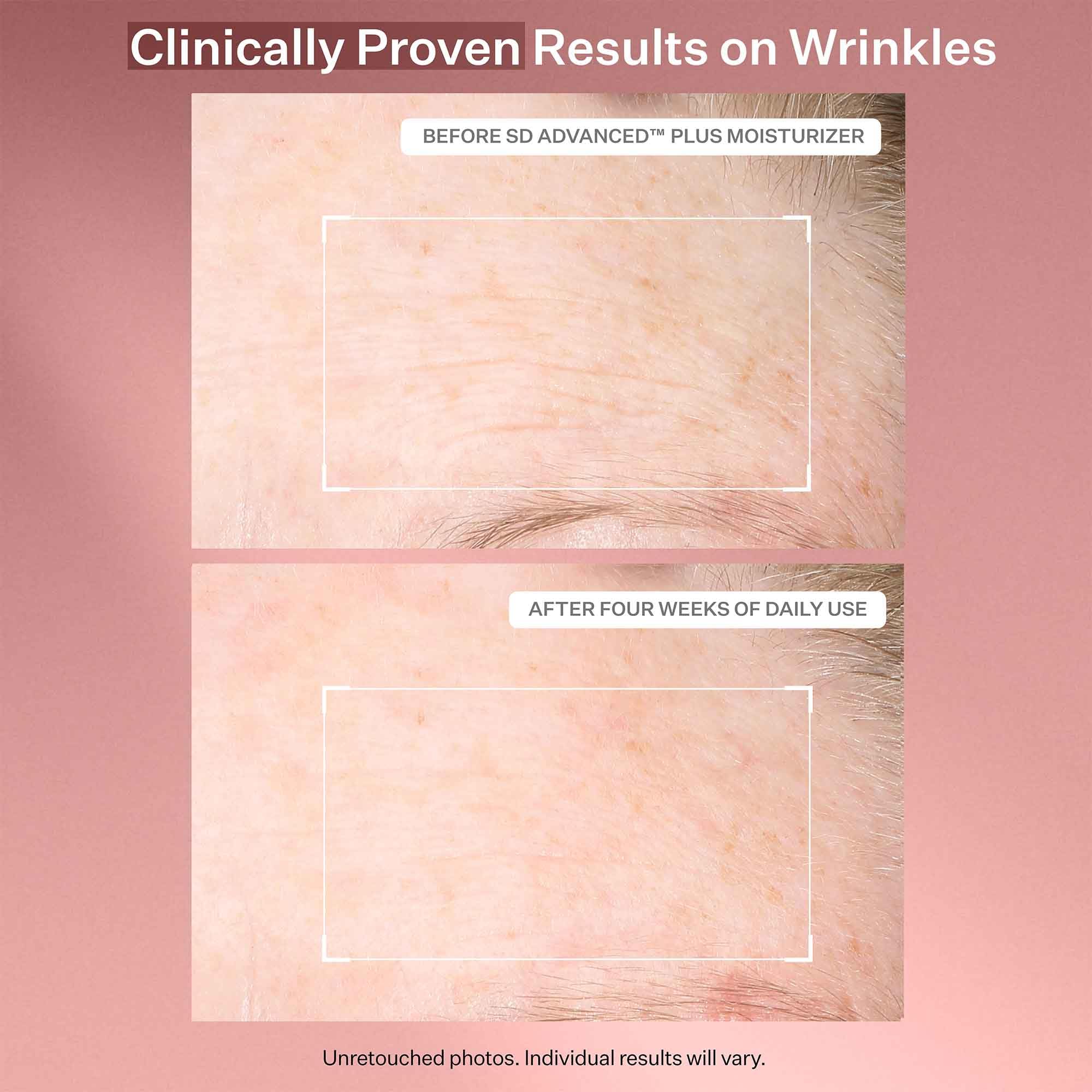 StriVectin SD Advanced™ Plus Intensive Moisturizer for Wrinkles & Stretch Marks - Anti-Aging Face & Body Cream with Collagen-Boosting Peptides & Hyaluronic Acid | Hydrating Skincare for Dry Skin, Fine Lines & Post-Pregnancy Care