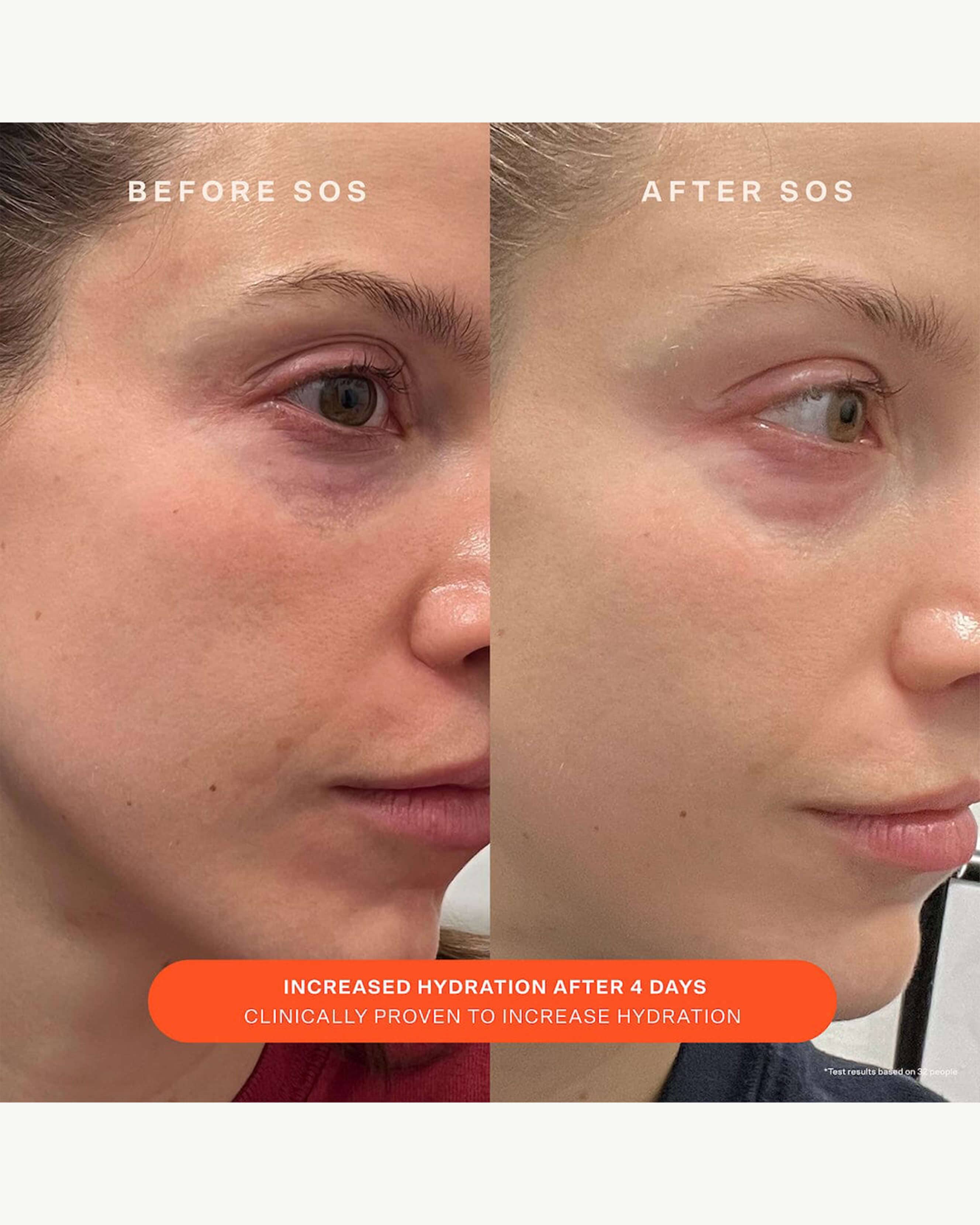 SOS Daily Barrier Recovery Cream for Dry, Sensitive Skin - Hydrating Moisturizer with Ceramides & Hyaluronic Acid - Perfect for Nighttime Skincare Routine & Post-Procedure Care