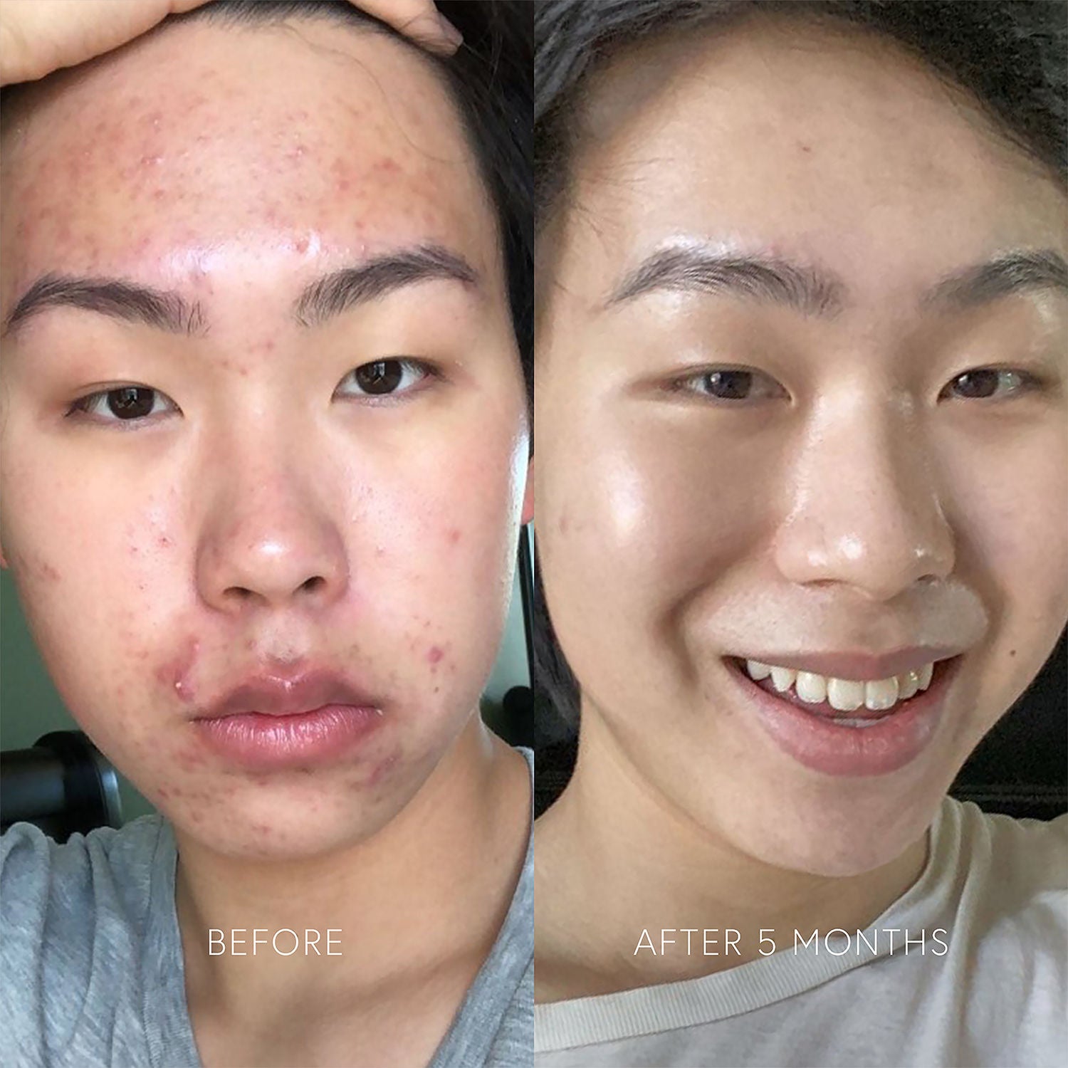 Best Clarifying Serum for Acne & Blemish Control - Brightening & Pore Minimizing Face Treatment - Perfect for Daily Skincare Routine & Nighttime Use
