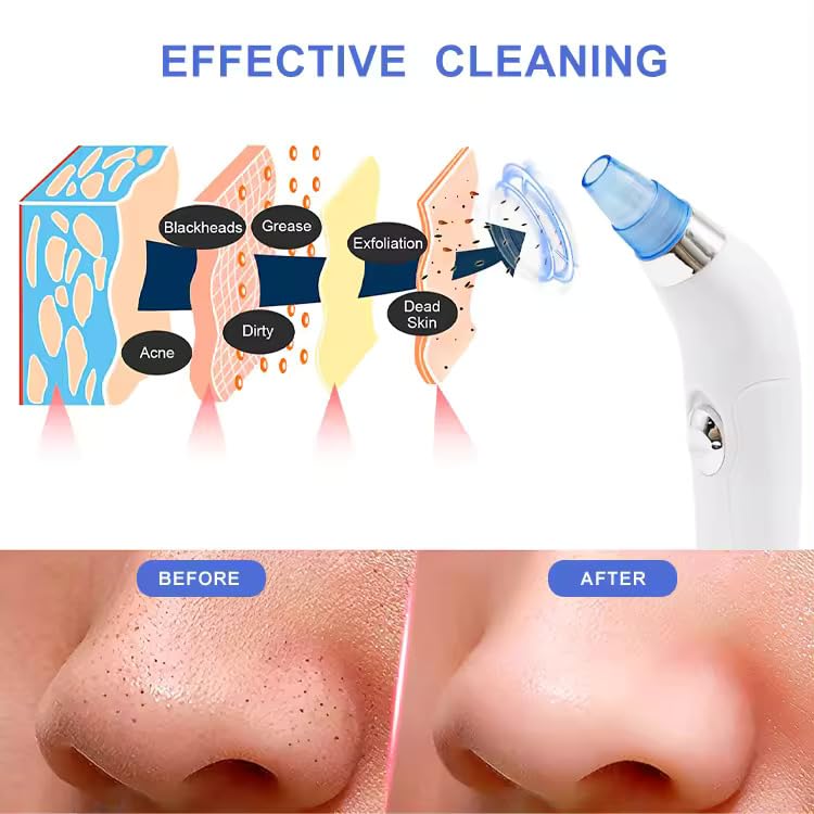 Viulvuk 4-in-1 Electric Blackhead Remover Vacuum Suction Tool | Professional Pore Cleaner for Face & Nose | Whitehead & Acne Treatment | Perfect for Home Skincare & Spa Facial Care