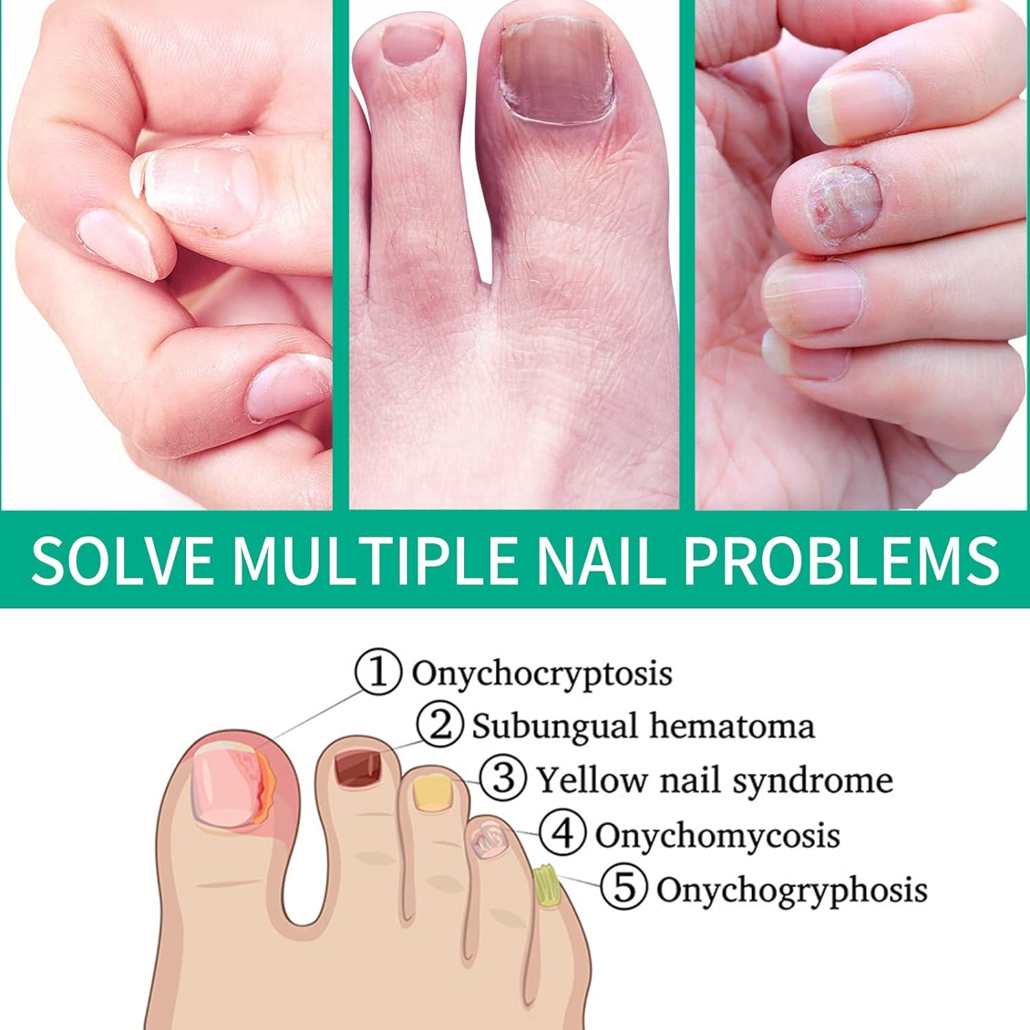 Extra Strength Toenail Fungus Treatment for Toenail & Fingernail - Fast-Acting Nail Repair Solution for Damaged & Discolored Nails - 1oz Cool Blue Renewal Liquid - Ideal for Athletes, Swimmers & Salon Professionals
