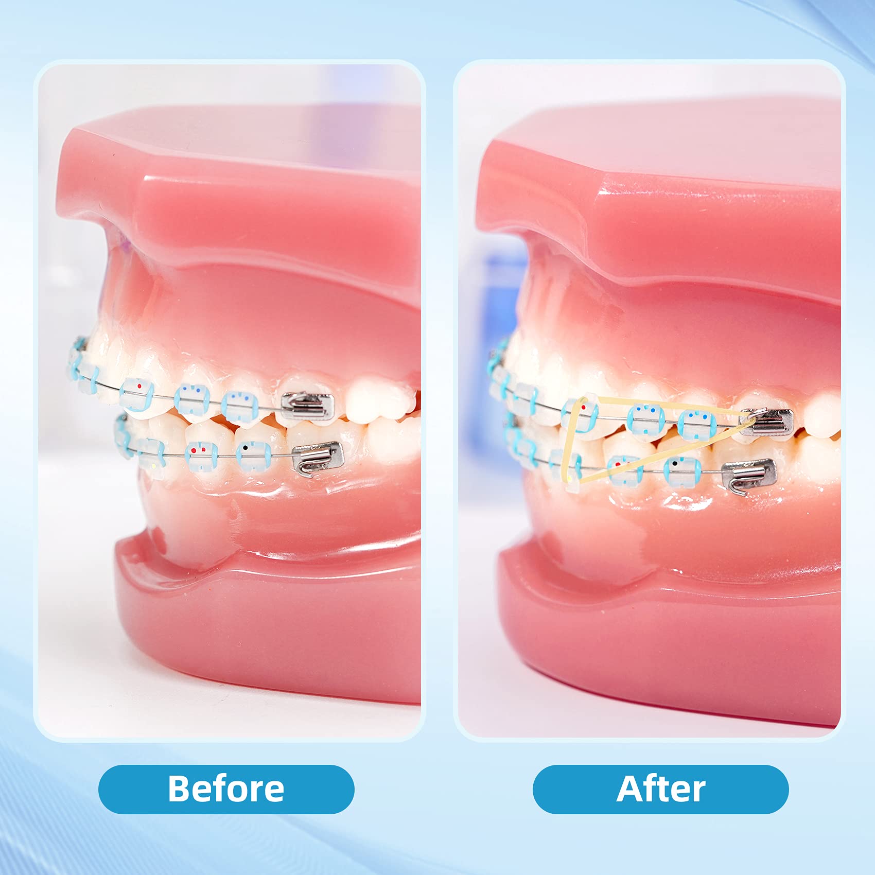 500 Pack Orthodontic Rubber Bands 5/16