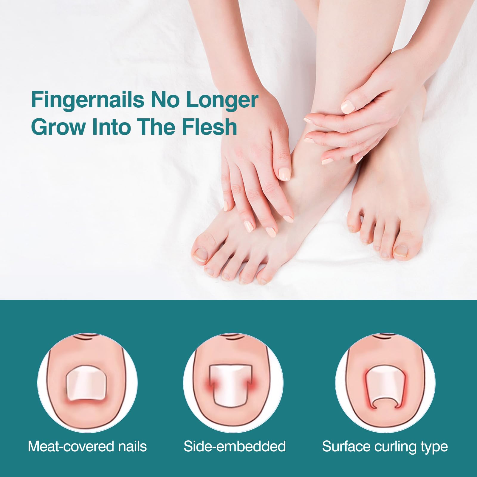 **Professional Ingrown Toenail Treatment Strips – 100 Pcs Pedicure Kit for Pain Relief & Toenail Correction – Ideal for Home Care & Salon Use**