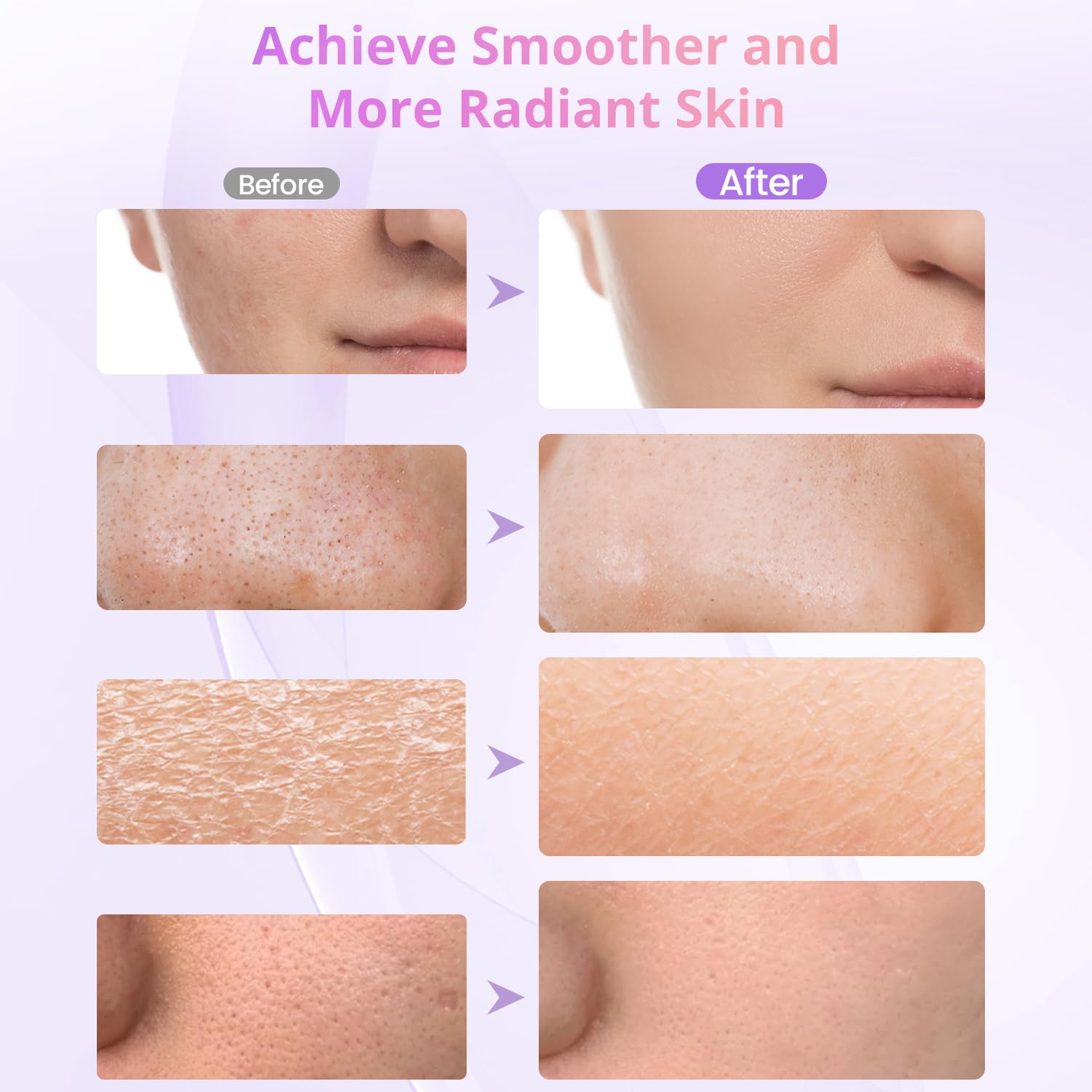 Diamond Microdermabrasion Machine - 3-in-1 Skin Exfoliator for Home & Salon Use