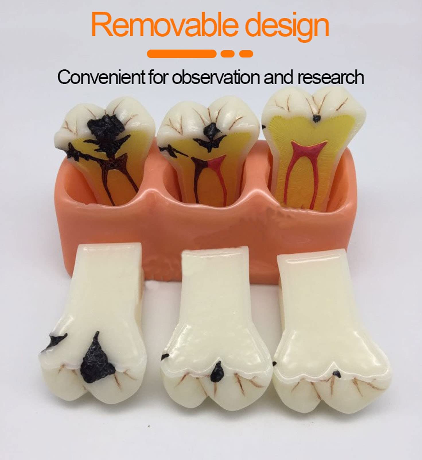 **Removable Dental Teeth Model - Caries & Tooth Decay Demonstration Kit for Dental Education, Teaching & Oral Health Training - Perfect for Dentists, Students & Classroom Learning**    *(Ideal for dental schools, clinics, patient education & hands-on training!)*