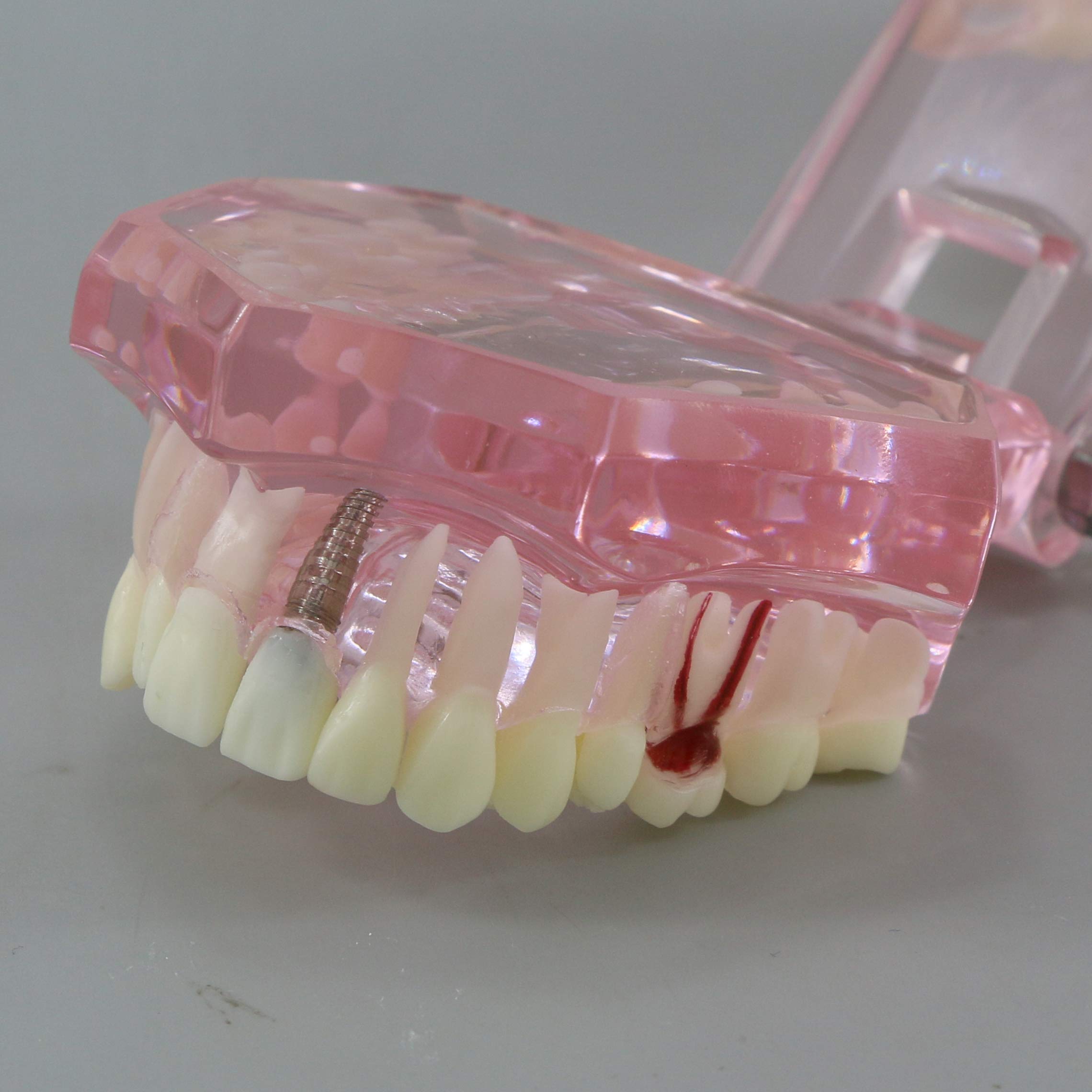 Dental Teeth Model - Implant Restoration Bridge Typodont for Dental Teaching & Study - Oral Pathology Demonstration (M2001 Pink) - Perfect for Dental Schools, Clinics & Training Labs