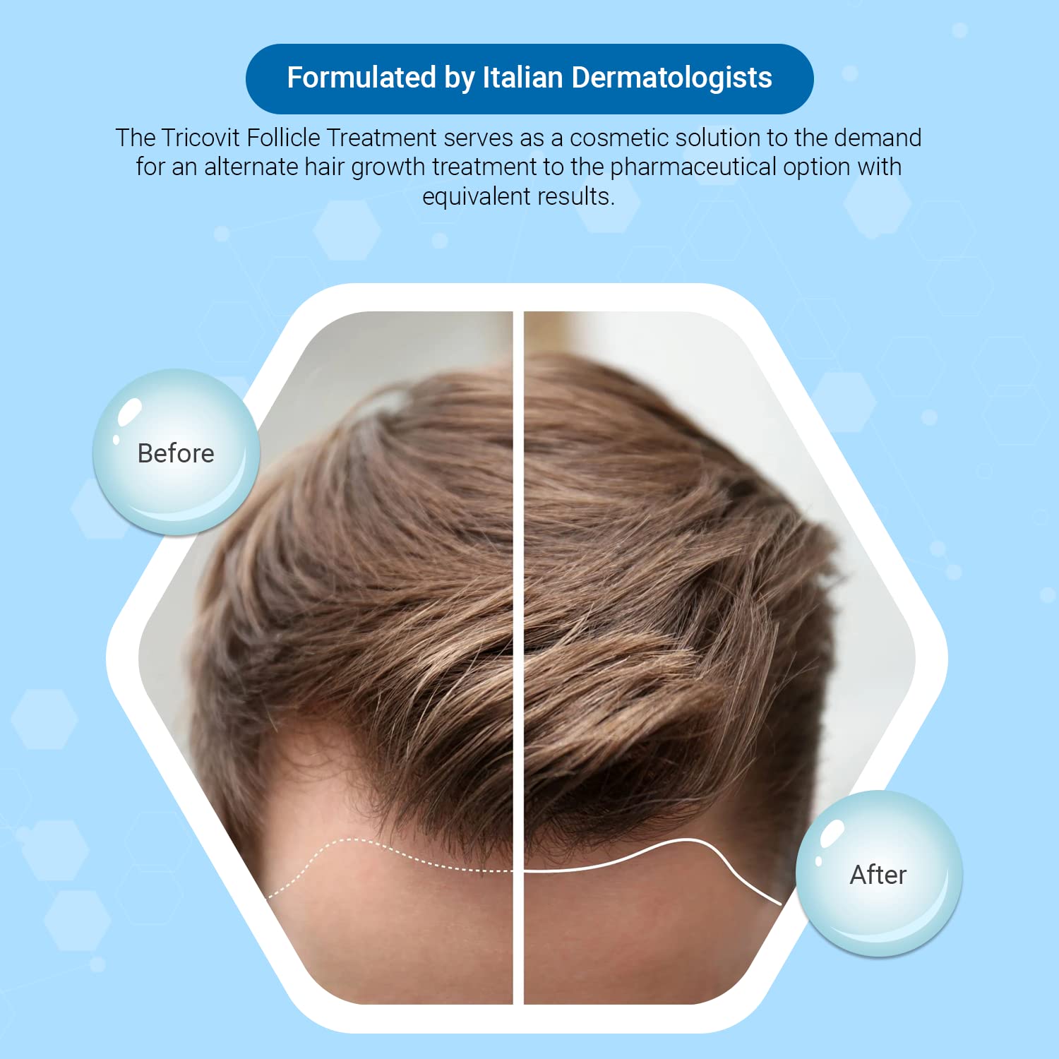 Tricovit Hair Growth Shampoo 8.4 oz + Pro Hair Nutrition Supplement 60 Gels + Forte Lotion with DHT Blockers 10 Packs - Natural Hair Regrowth Treatment for Men & Women - Use for Thinning Hair, Baldness Prevention & Scalp Health