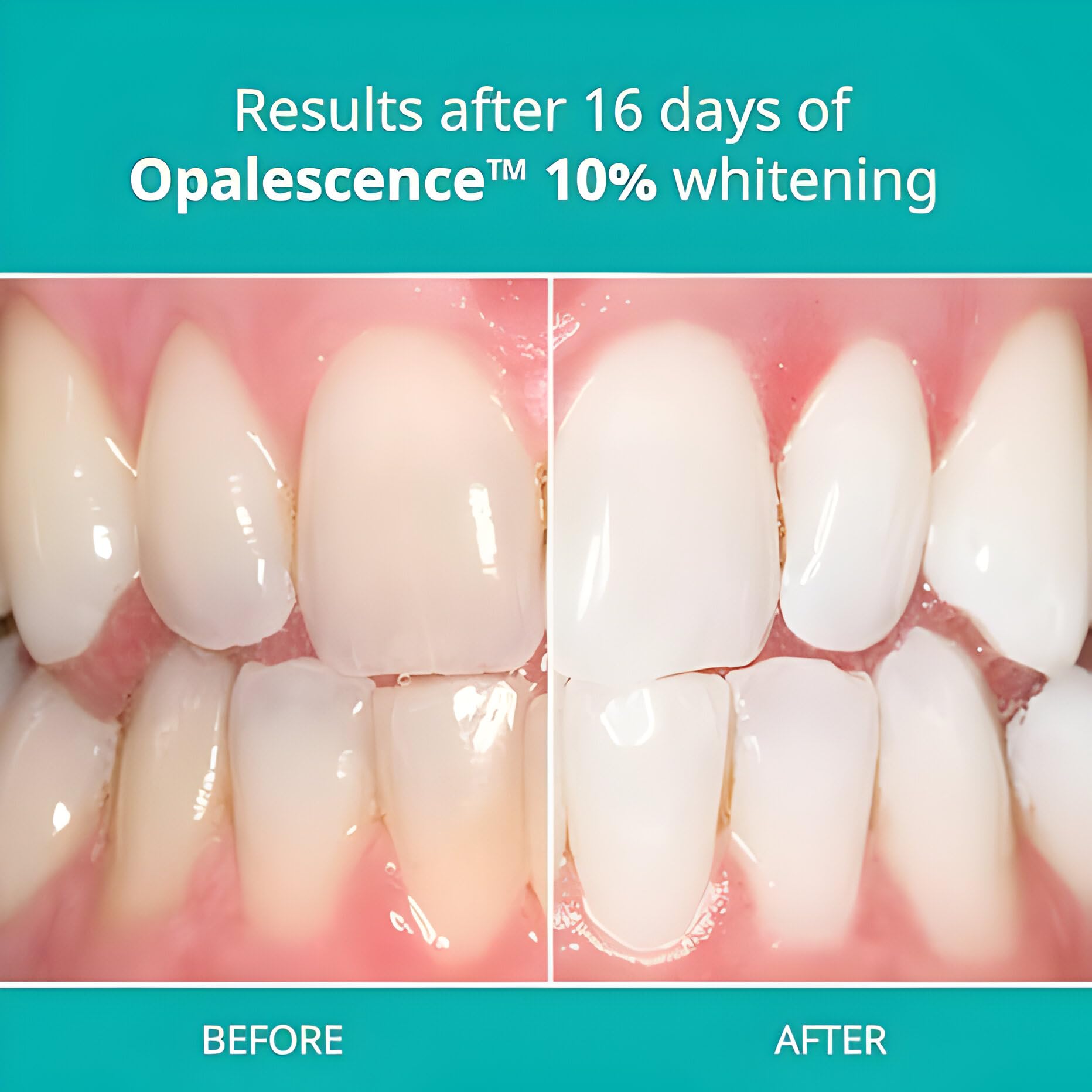 Opalescence 10% Teeth Whitening Kit with Carbamide Peroxide - 2 Pack (4 Gel Syringes) for Sensitive Teeth - Fluoride Enamel Safe - Professional Whitening Treatment at Home - Made in USA | Brighten Smile for Weddings, Photos & Special Events