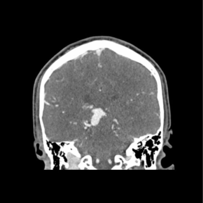 CTA AVM / Lesion Head Phantom - High-Quality CT Scan & X-Ray Training Tool for Medical Students & Radiology Professionals | Perfect for Diagnostic Imaging Practice & Medical Education