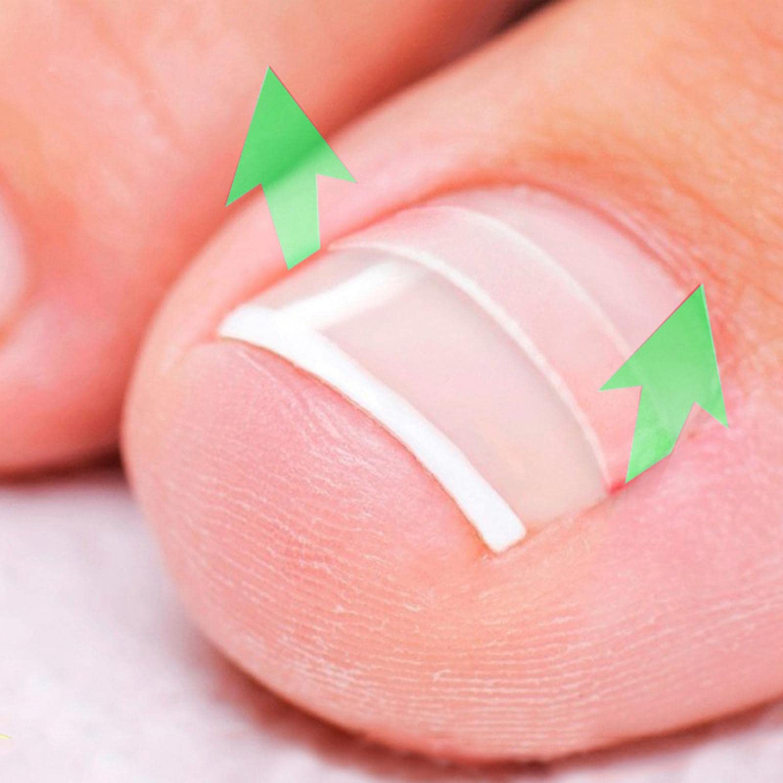 LOSA Ingrown Toenail Treatment - Professional Ingrown Toenail Correction Tool for Pain Relief & Pedicure Care | Perfect for Home Use, Salon Treatments & Foot Care Routines