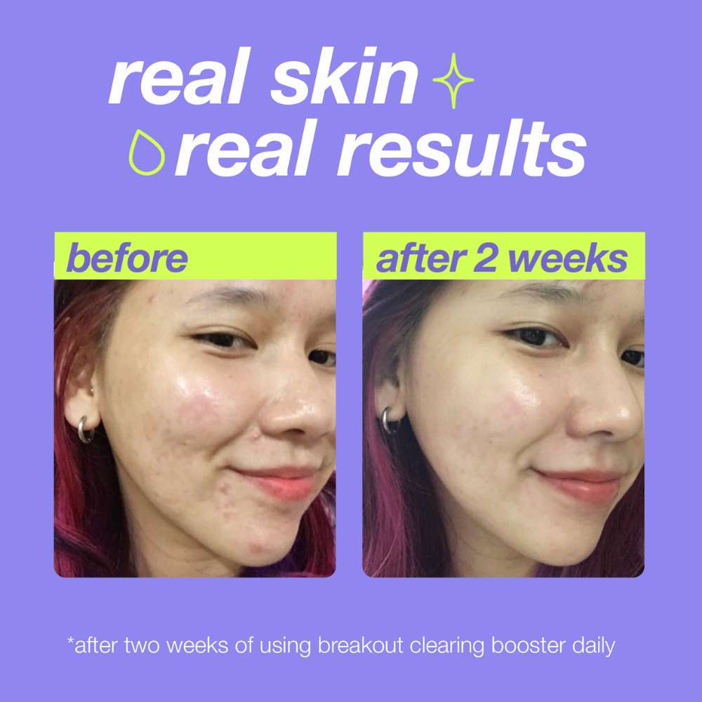 Breakout Clearing Booster - Acne Treatment for Clear Skin | Best for Oily & Sensitive Skin | Use Daily for Blemish-Free Complexion
