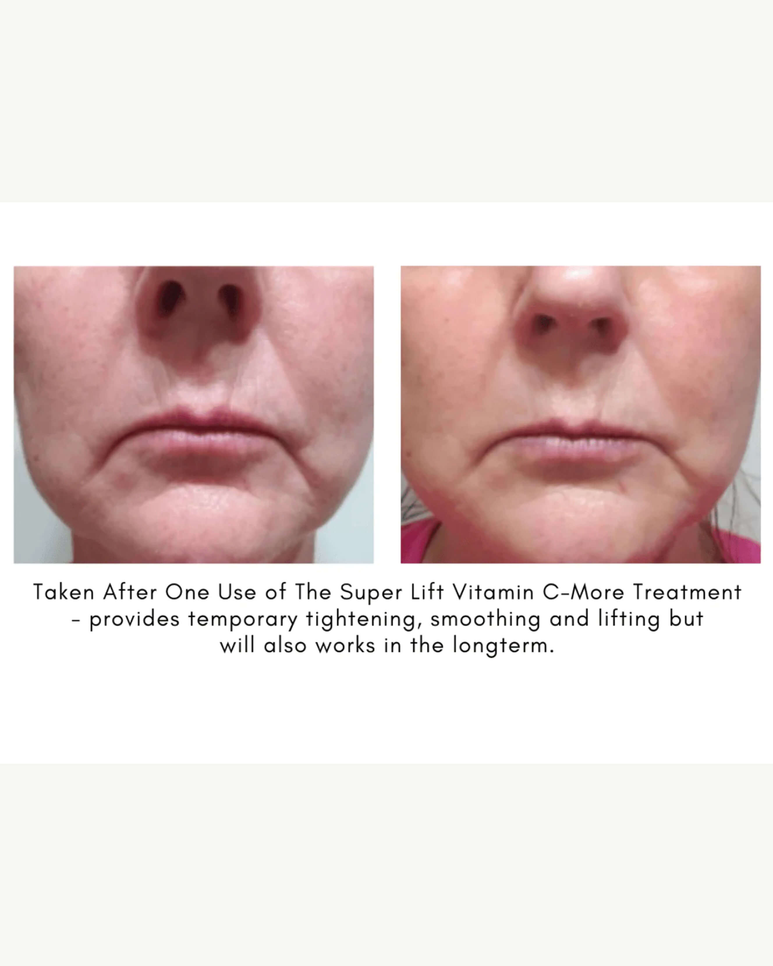 Vitamin C Super Lift Treatment Serum - Brightening & Anti-Aging Face Care for Glowing Skin | Day & Night Moisturizer for Women & Men