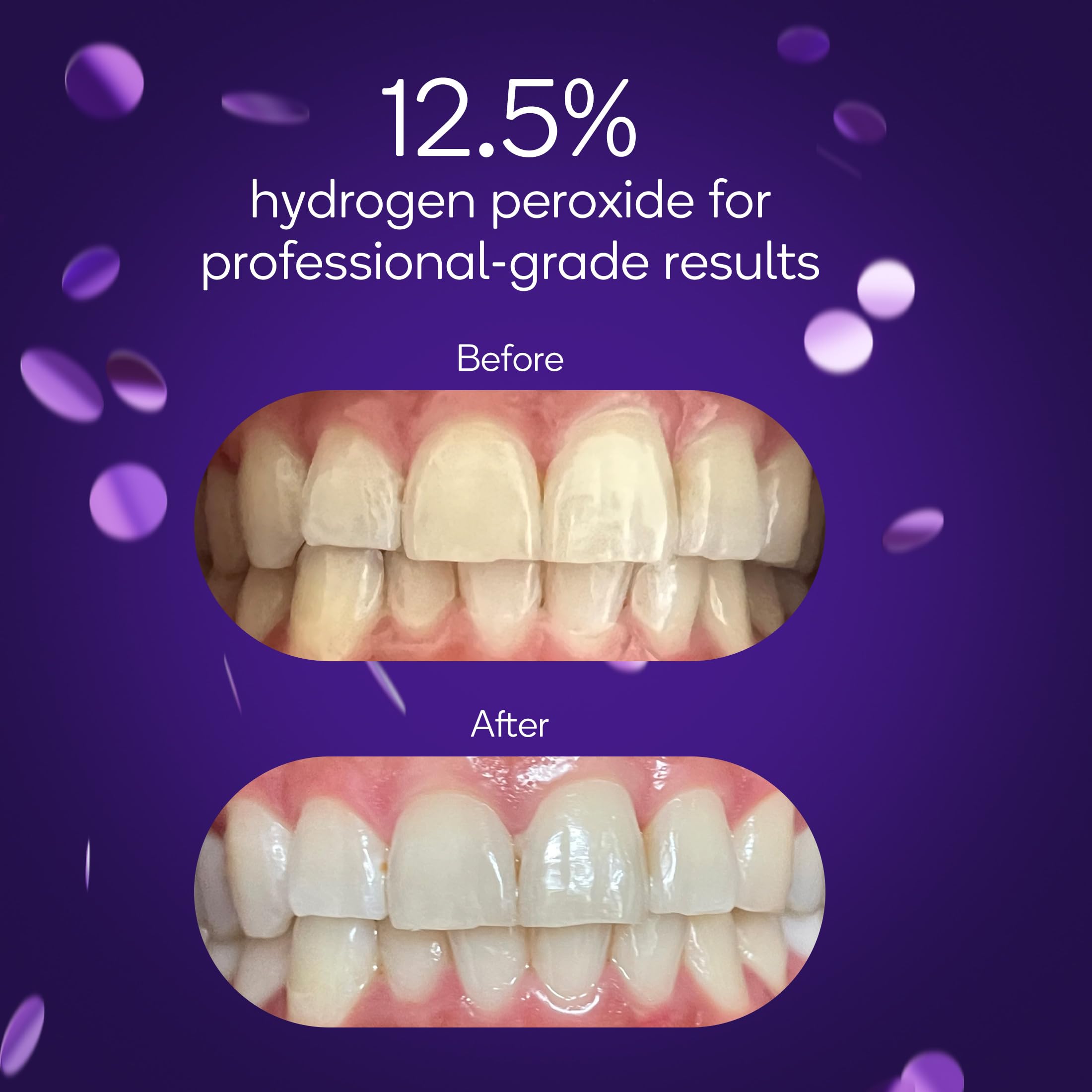 BURST Sensitive Teeth Whitening Kit with 12.5% Hydrogen Peroxide - 3 Treatments for Teeth Whitening, Up to 3 Shades Whiter After First Use, Prefilled Gel Trays - Perfect for Sensitive Teeth & Quick Results Before Special Occasions