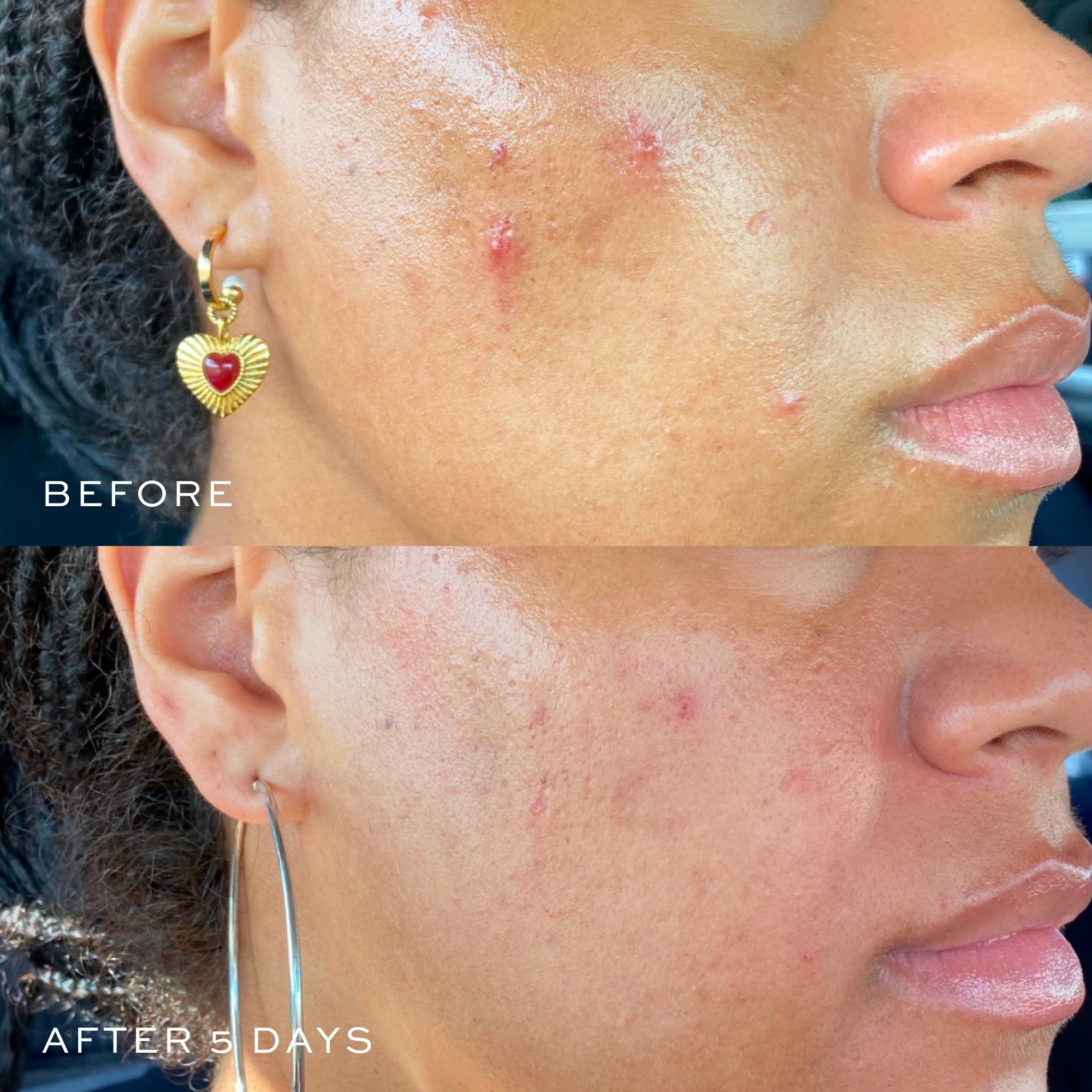 Best Acne Spot Treatment for Fast Results - Clear Pimples & Blemishes Overnight | Perfect for Teens & Adults with Oily or Sensitive Skin