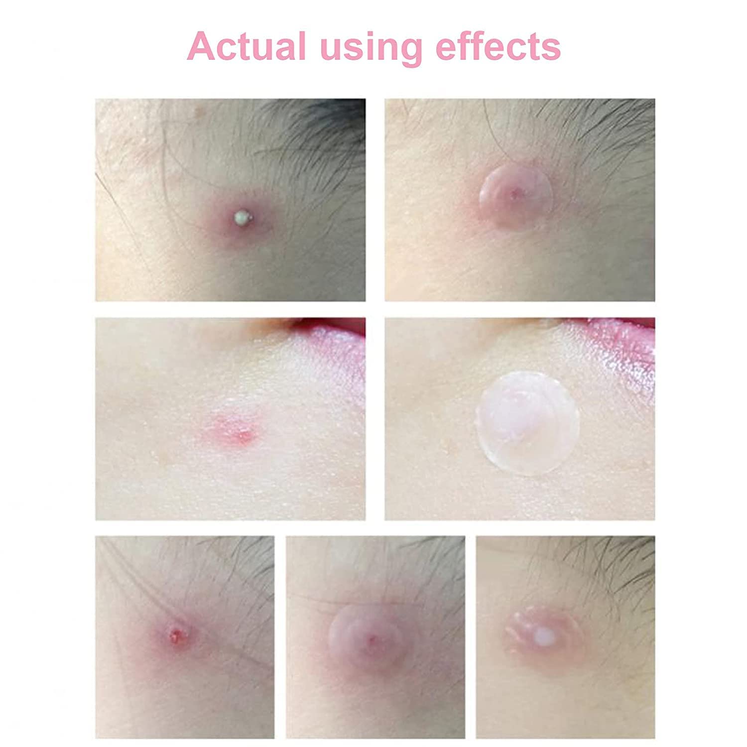 WENGONVILA Acne Pimple Patch - Invisible Hydrocolloid Facial Stickers for Zits & Blemishes (36 Count) - Clear Spot Treatment for Day & Night Use, Perfect for School, Work & Travel