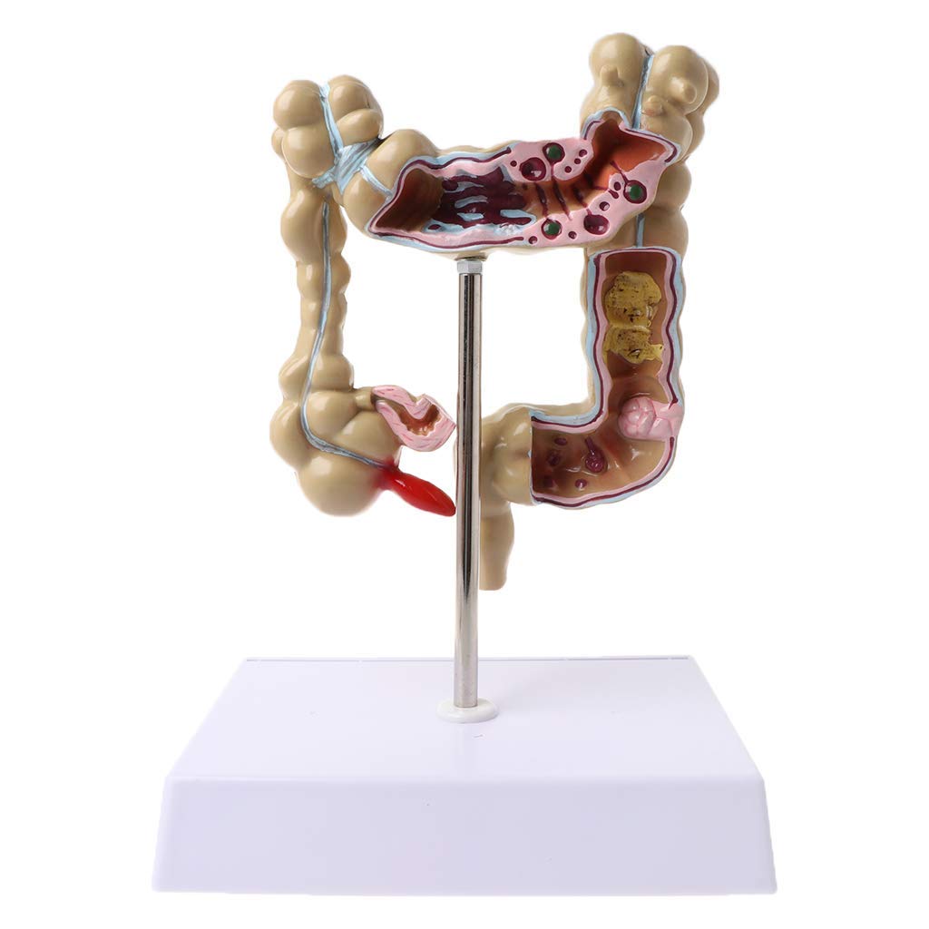 Educational Human Colorectal Lesion Anatomical Model - Pathological Colon Disease Intestine Medical Teaching Tool for Doctors & Students | Perfect for Medical School, Hospital Training & Patient Education