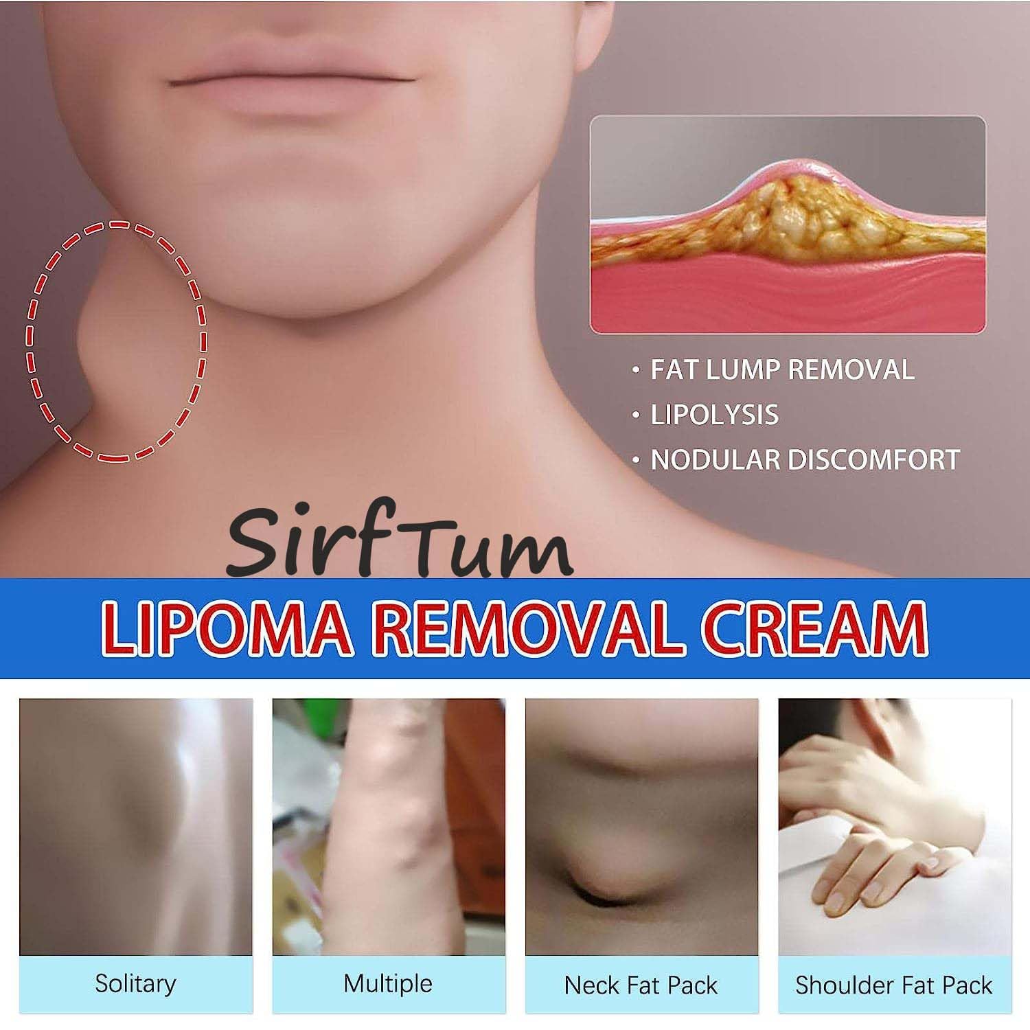 Painless Wart Remover Cream for Skin, Face & Corns - Effective Treatment for Acne, Moles, Scars & Lipoma | SIRF TUM 7 Fast-Acting Ointment | Gentle Skin Care Solution for Smooth & Clear Complexion | Perfect for Home Use & Dermatological Care