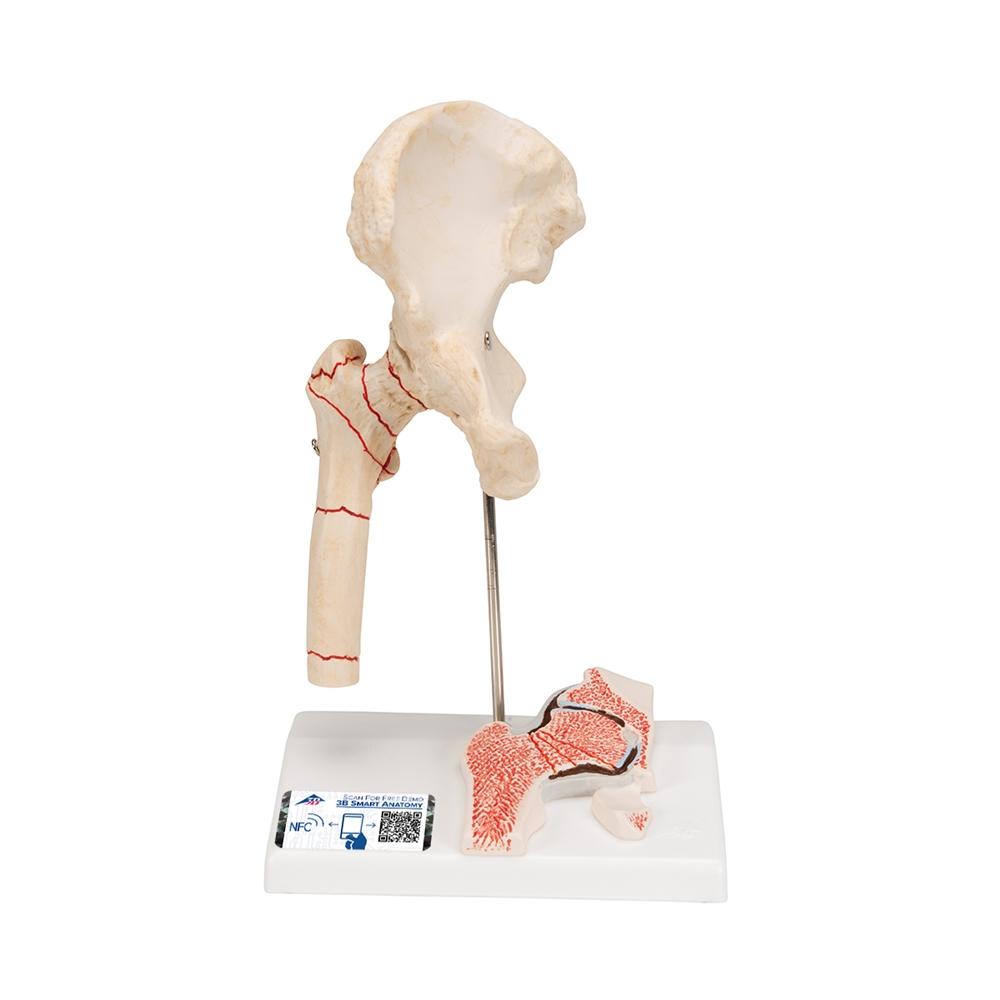 Femoral Fracture & Hip Osteoarthritis Anatomical Model - Medical Training, Student Education, and Clinical Demonstration Tool