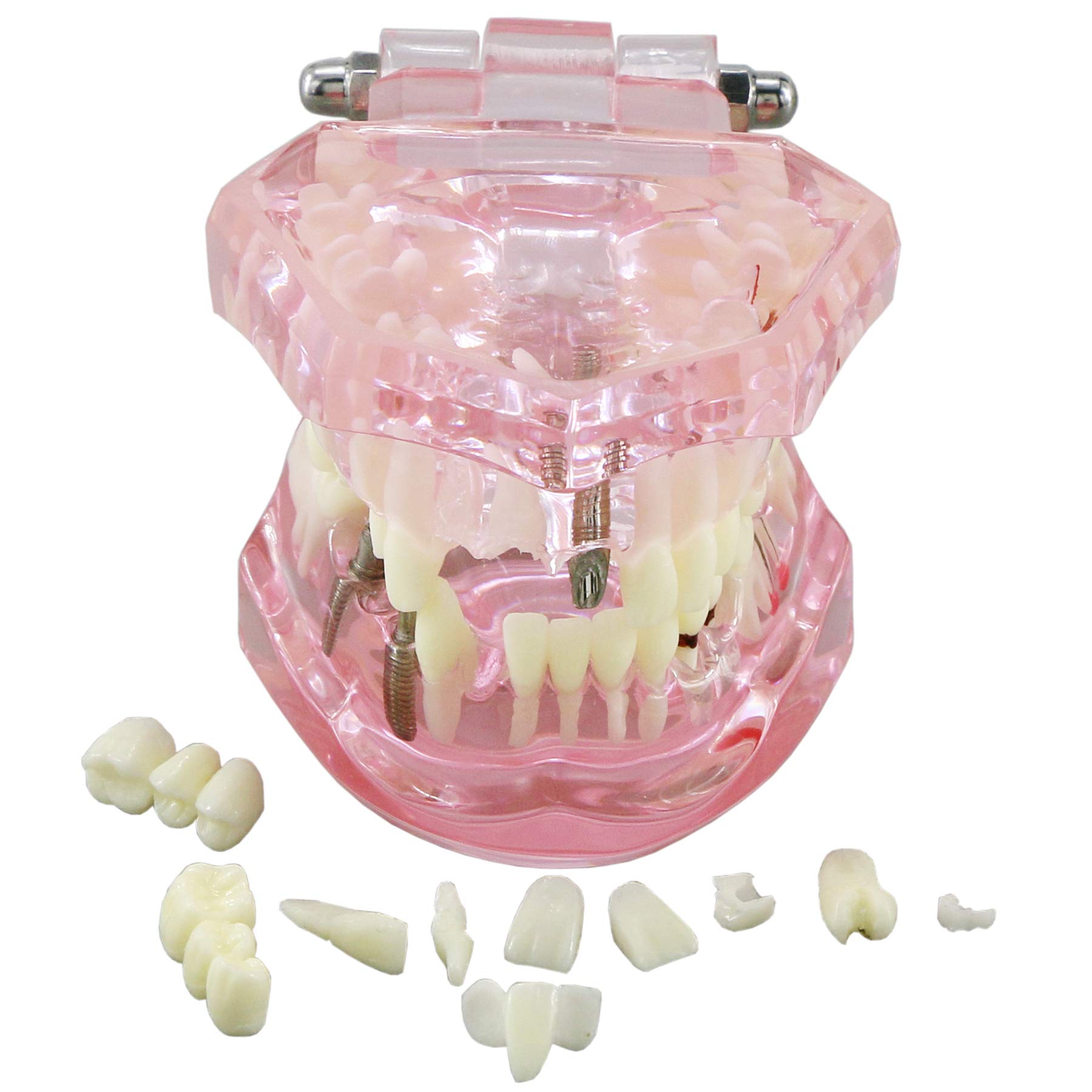 Dental Teeth Model - Implant Restoration Bridge Typodont for Dental Teaching & Study - Oral Pathology Demonstration (M2001 Pink) - Perfect for Dental Schools, Clinics & Training Labs