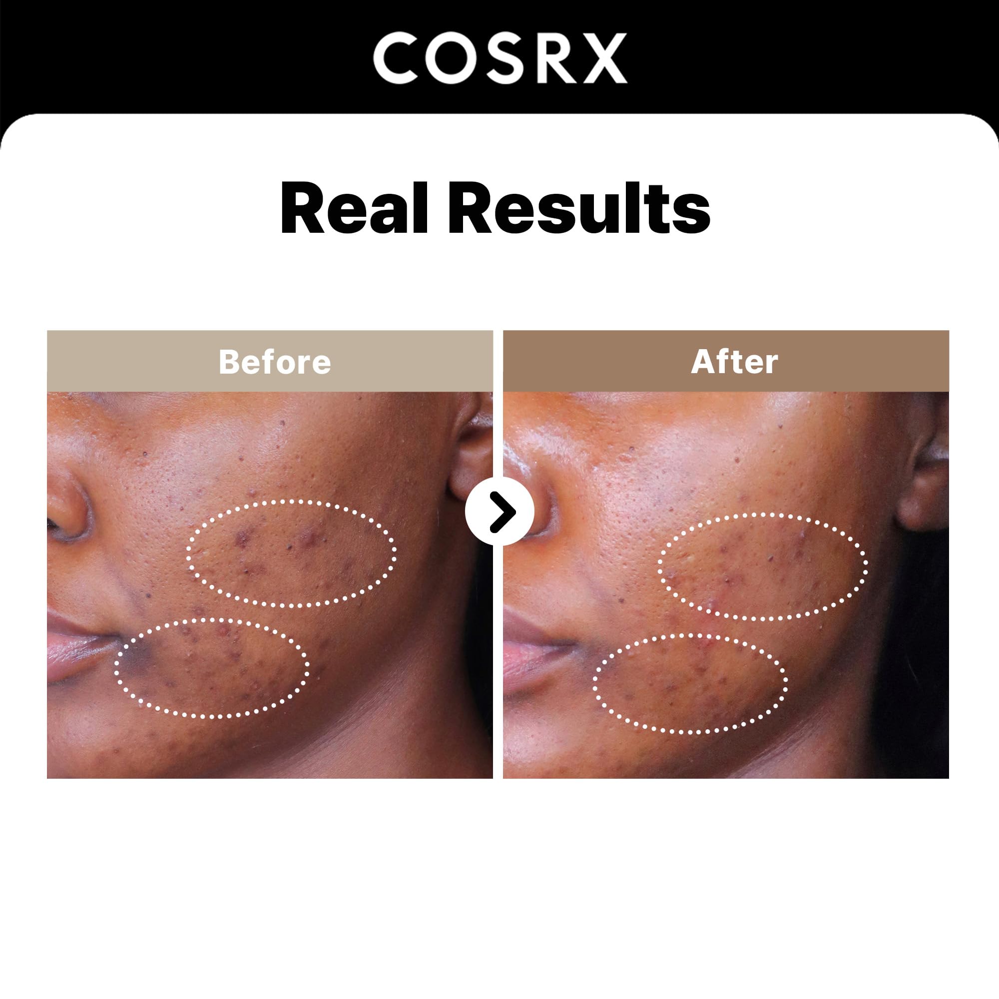 COSRX 2% Alpha Arbutin Face Serum with Niacinamide - Brightening Korean Skincare for Dark Spots & Hyperpigmentation