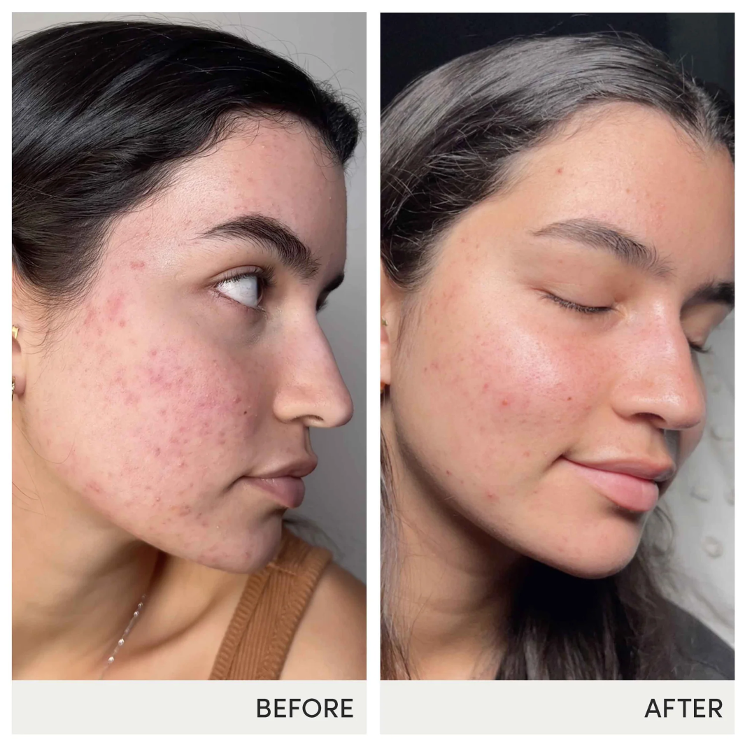 Jane Iredale Skin Accumax - Clear Skin Supplement for Acne & Blemishes | Vegan, Cruelty-Free Skincare | Perfect for Daily Use & Travel